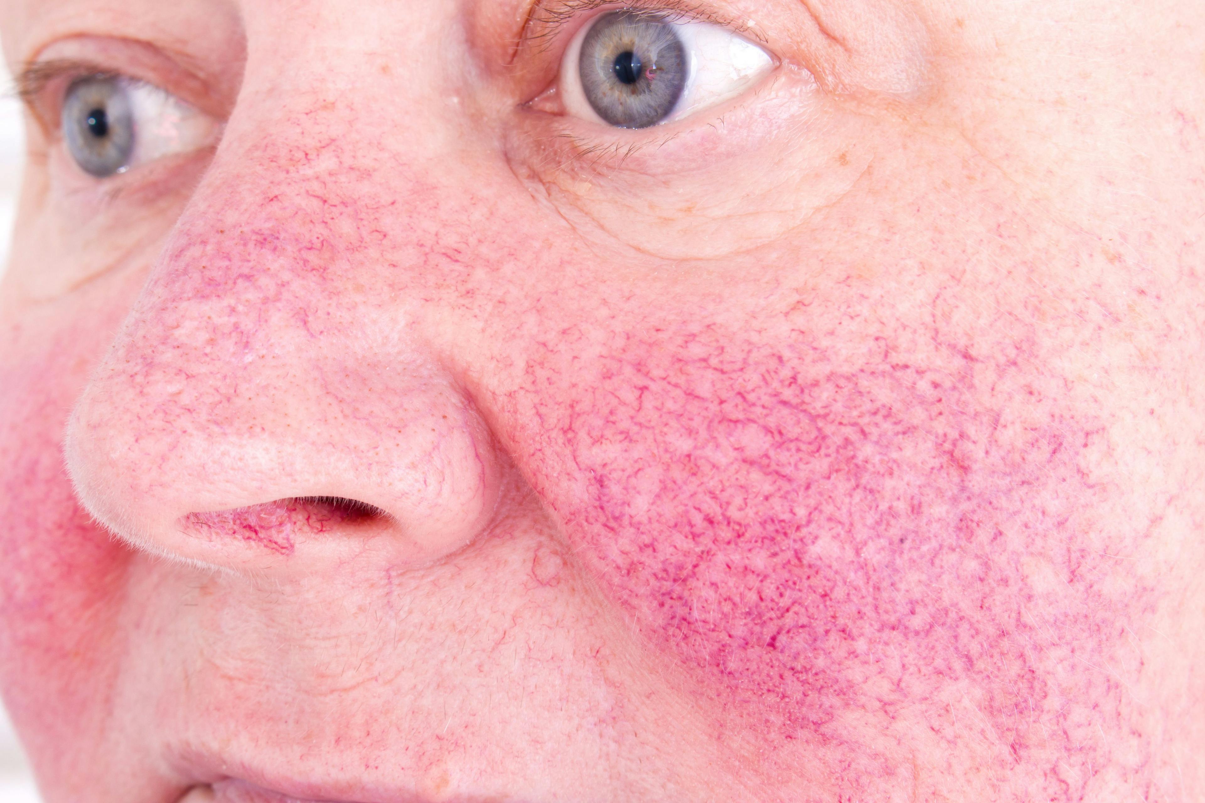 Close up of red patches on face cause by rosacea