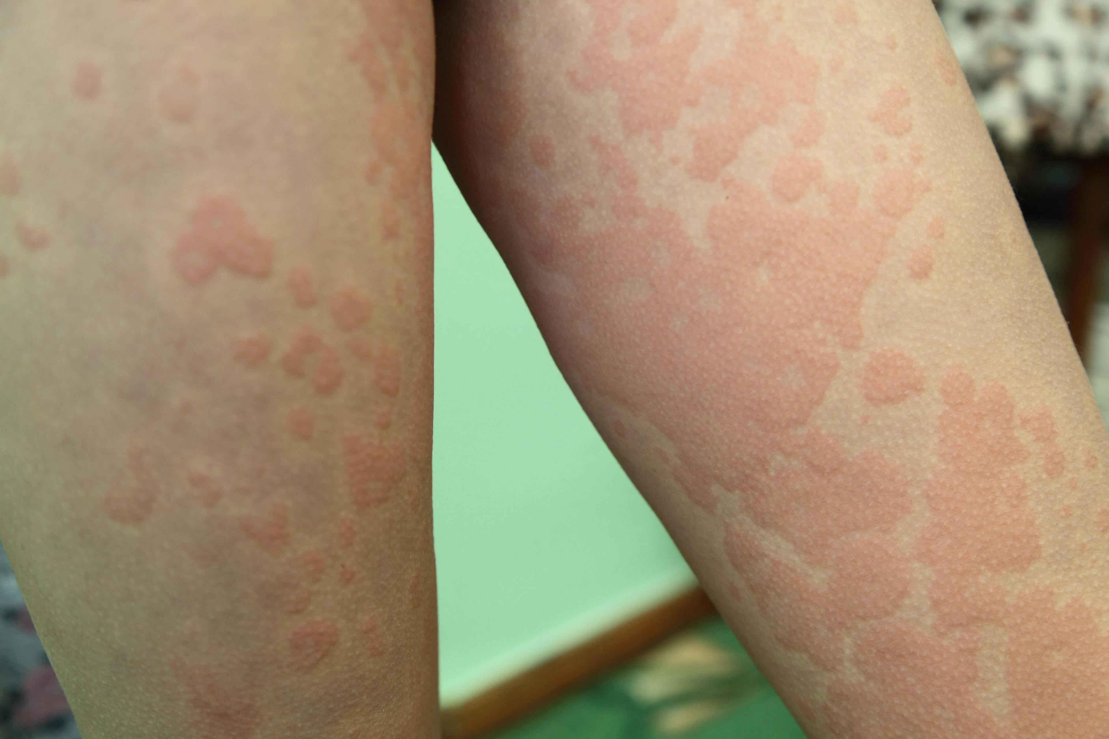 Japan Approves Dupilumab for Chronic Spontaneous Urticaria
