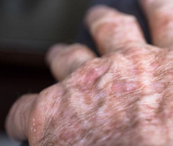 Lesions of actinic keratosis or sunspots on sun-damaged skin of the hand of a man