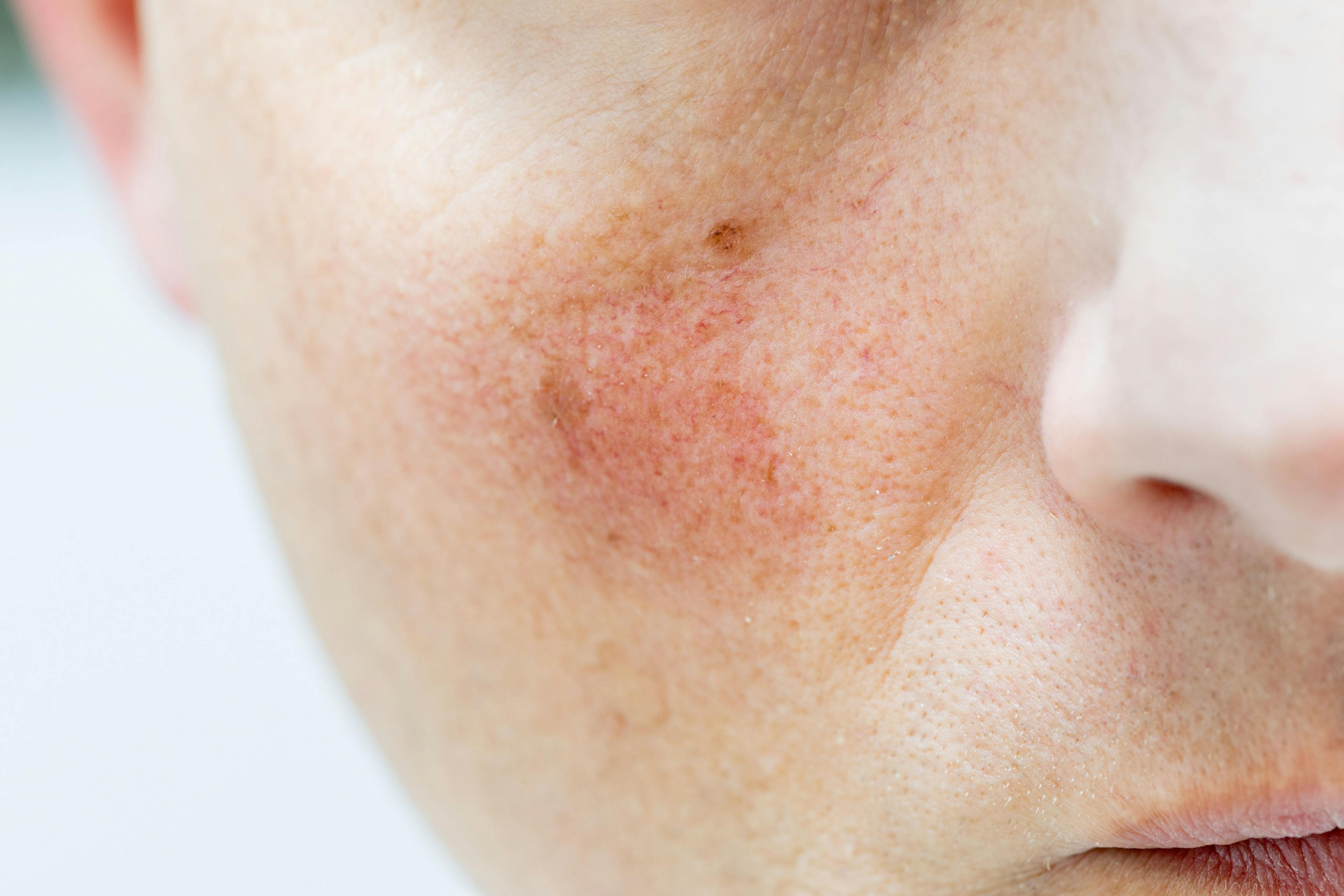 PROMs Rarely Used in Randomized Clinical Trials for Acne and Rosacea  