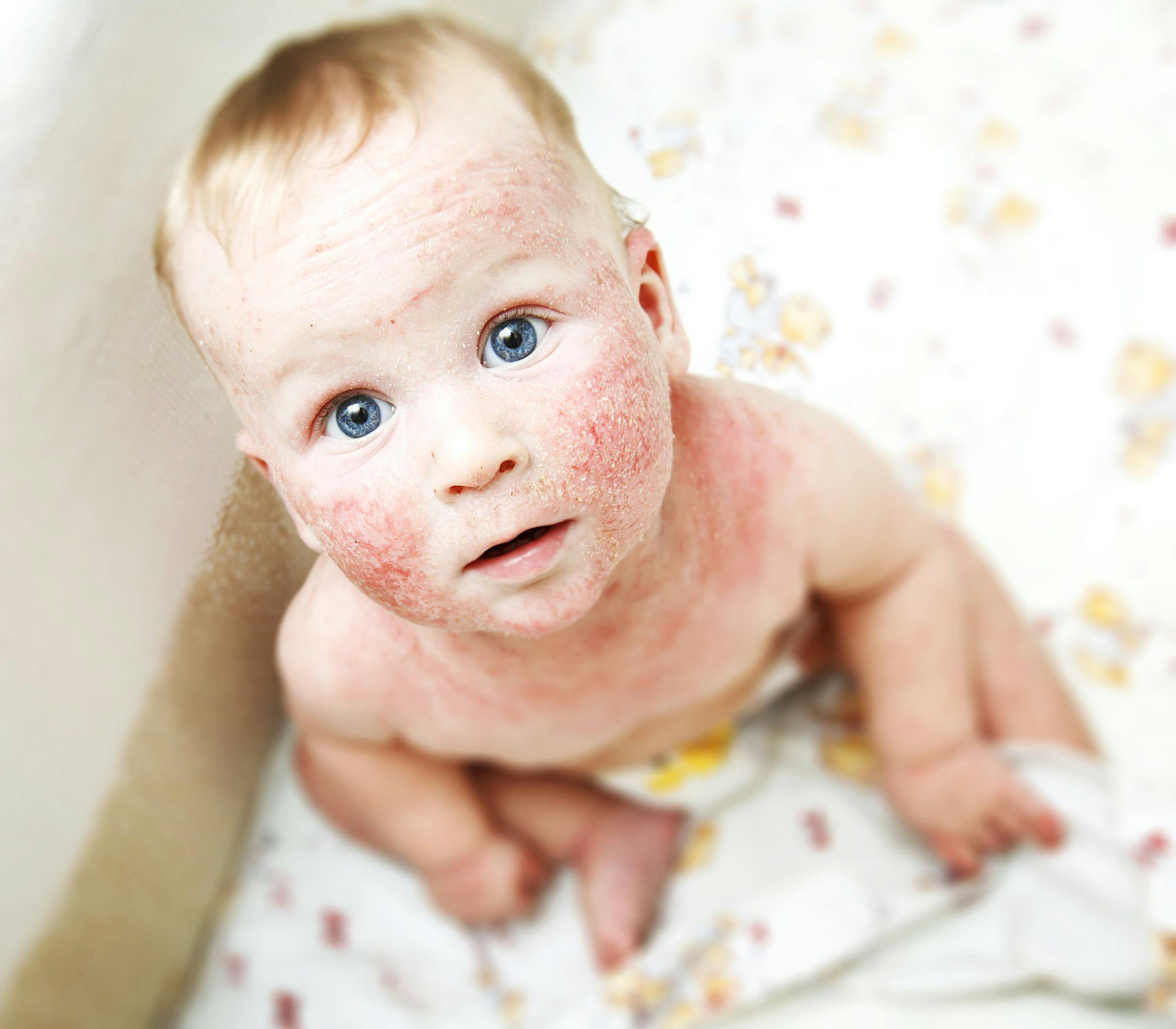 baby with atopic dermatitis