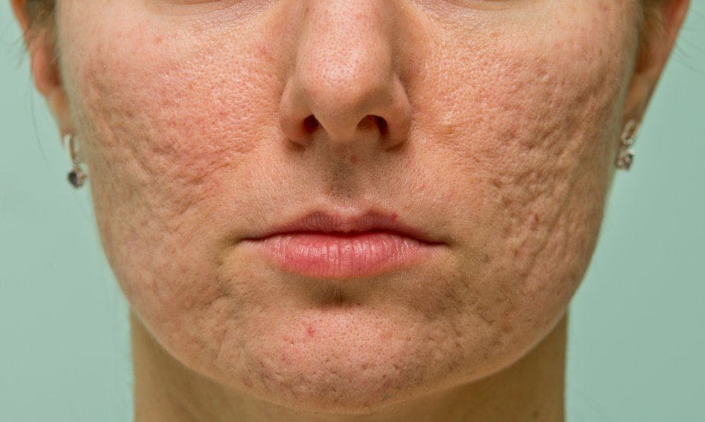 acne scars on female face
