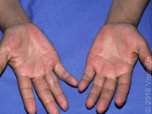lesions on palms of hands