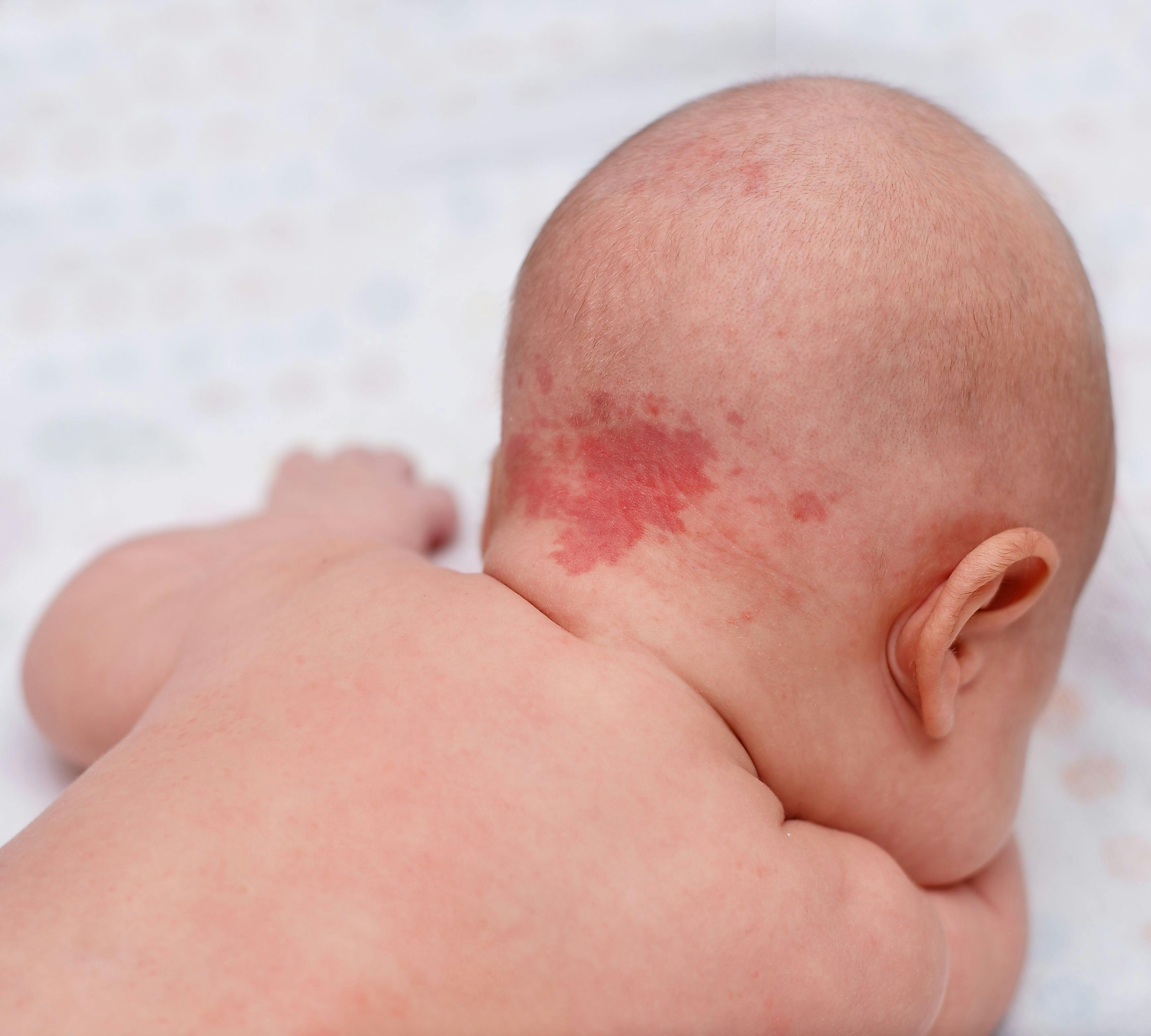 Monique Kumar, MD, Shares the Lessons She Learned When Her Child was Born with a Port Wine Birthmark