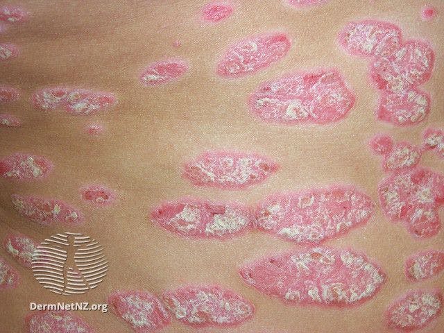 Well-demarcated plaques with silvery scale in chronic plaque psoriasis

Image courtesy of DermNet