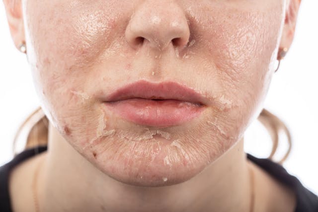 Evaluating the Efficacy and Safety of Organic Acids in Chemical Peels for Acne