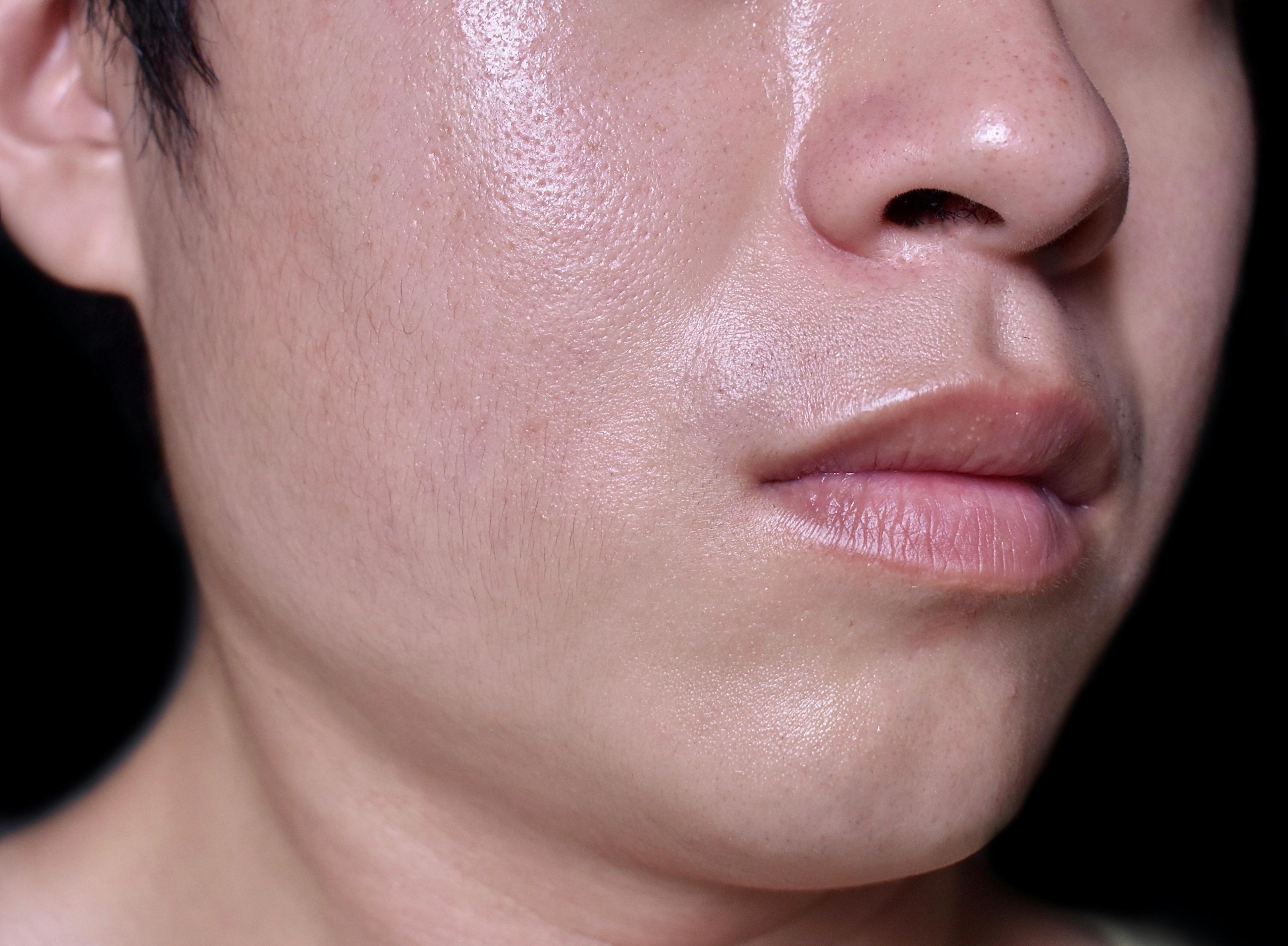 Anti-Sebum Cream Efficacious in Sebum Reduction, Improved Skin Hydration
