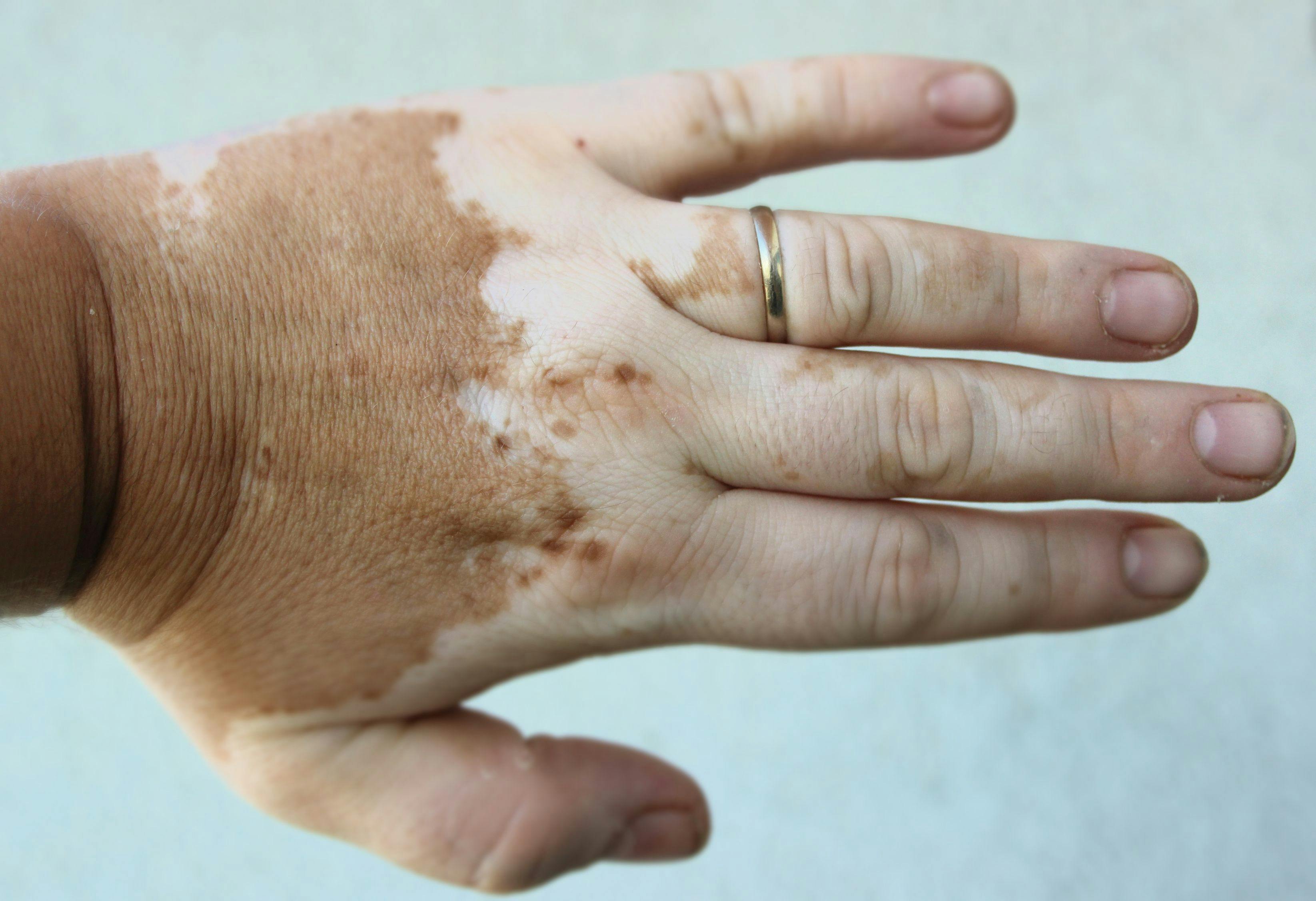 Research Presented at AAD Explores Relationship Between Vitiligo and Skin Tone Bias in Google Searches