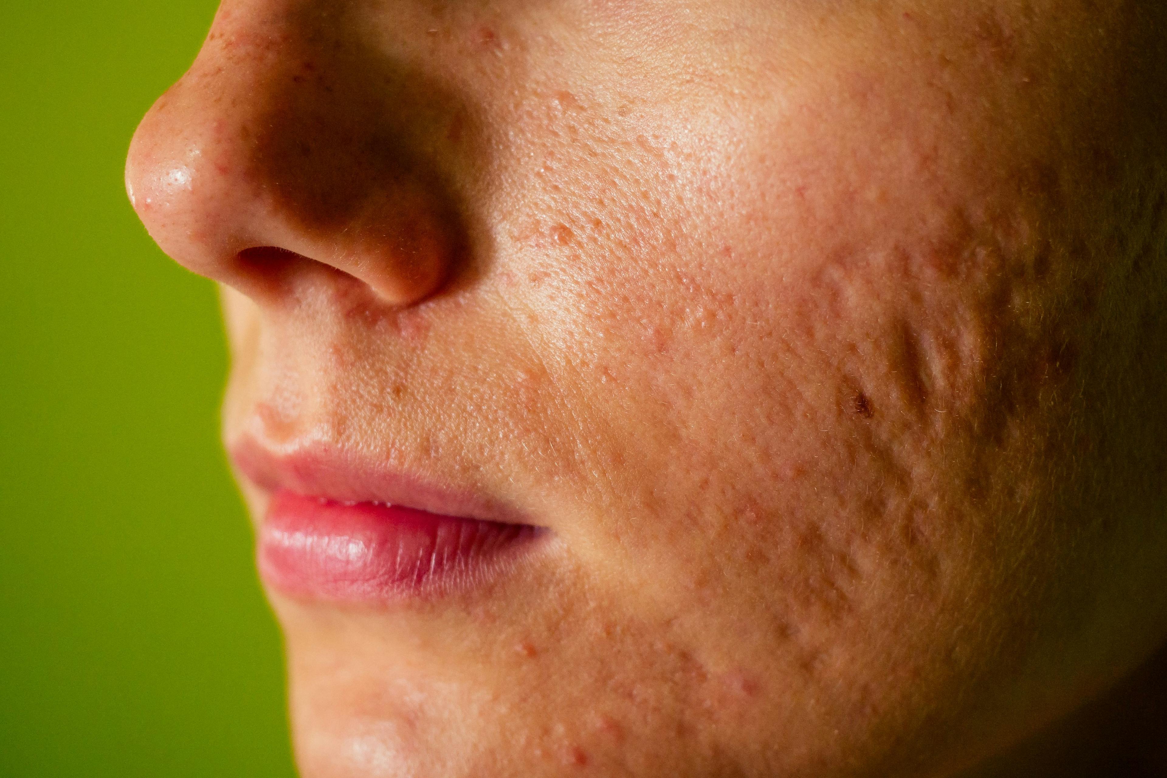 woman with atrophic acne scars