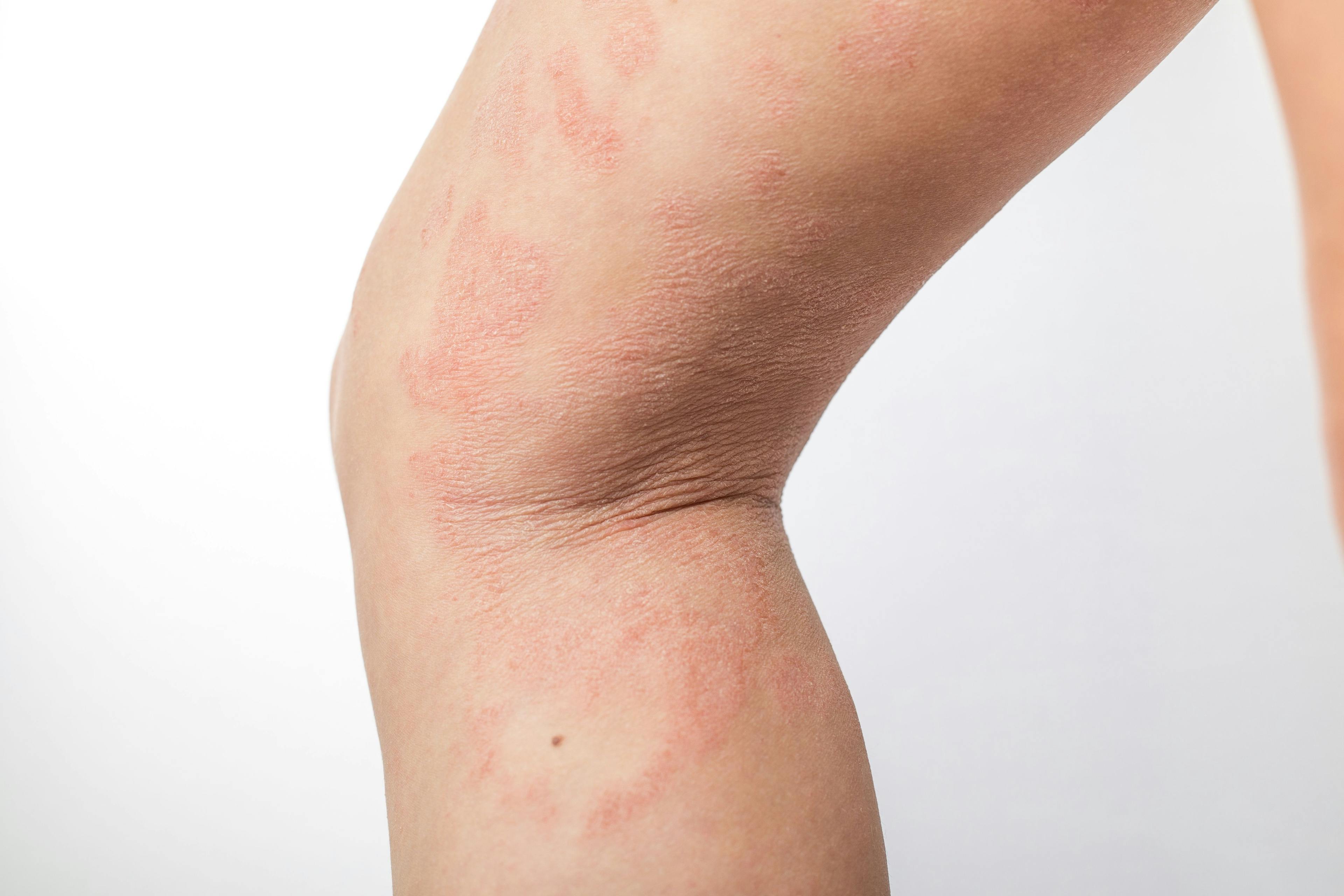Delgocitinib Effective in Treatment of Mild to Moderate Atopic Dermatitis