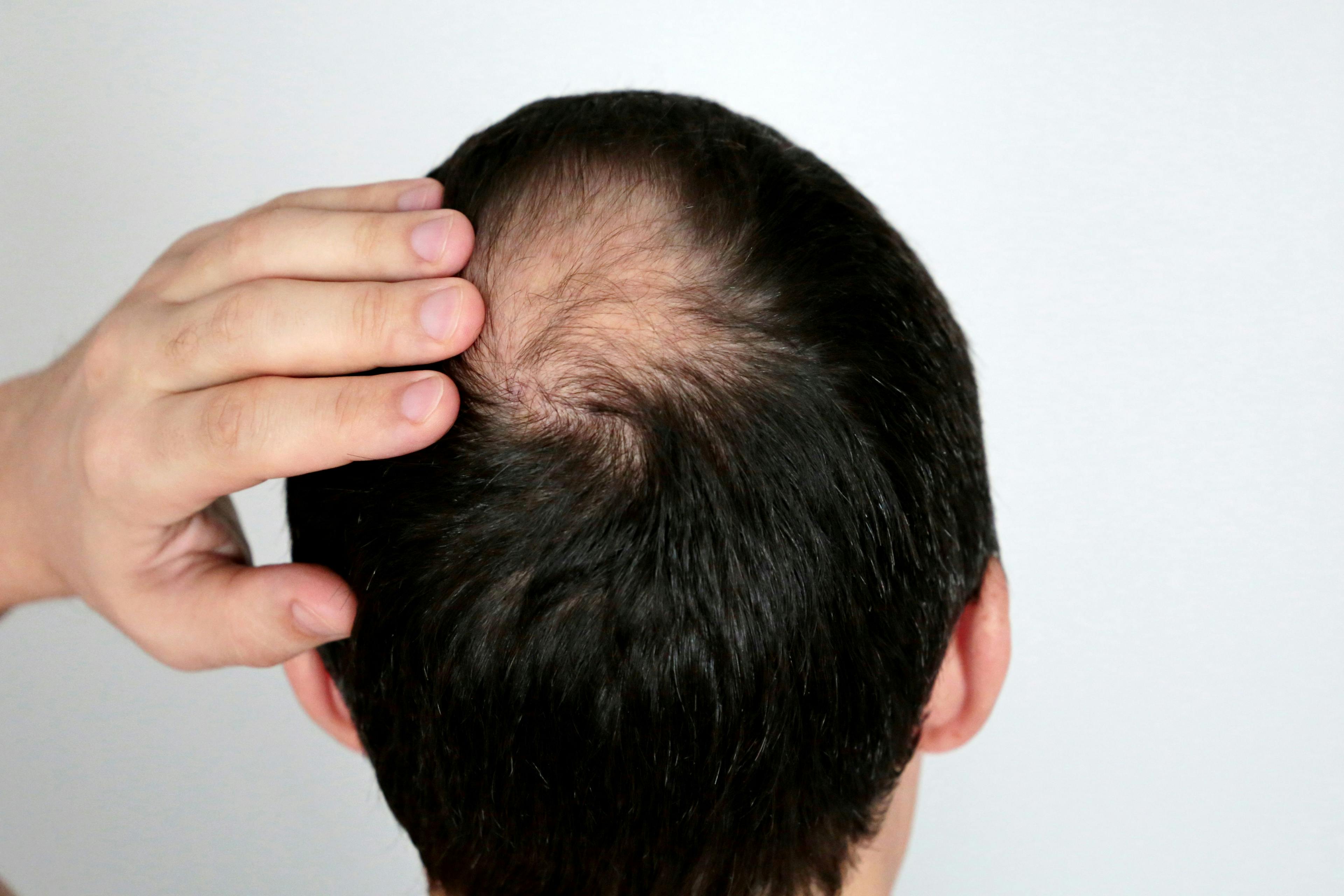 Top Treatment Interventions for Scarring Alopecias