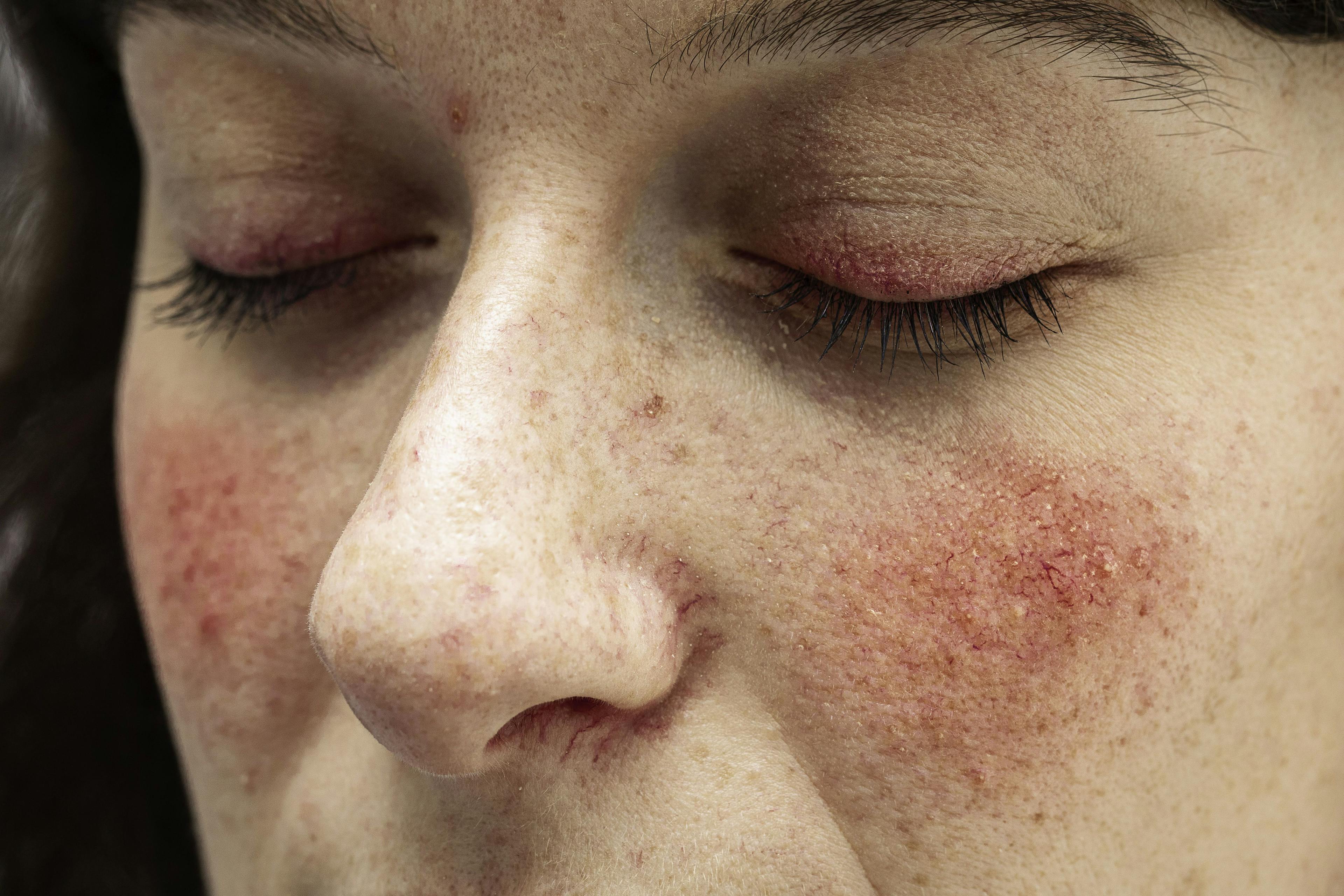Drug Watch: What's Coming in the Rosacea Pipeline