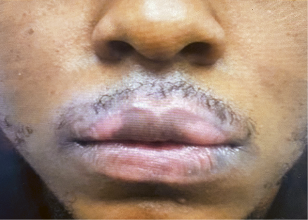 Case Report: Repigmentation of the Lips Using Ruxolitinib 
