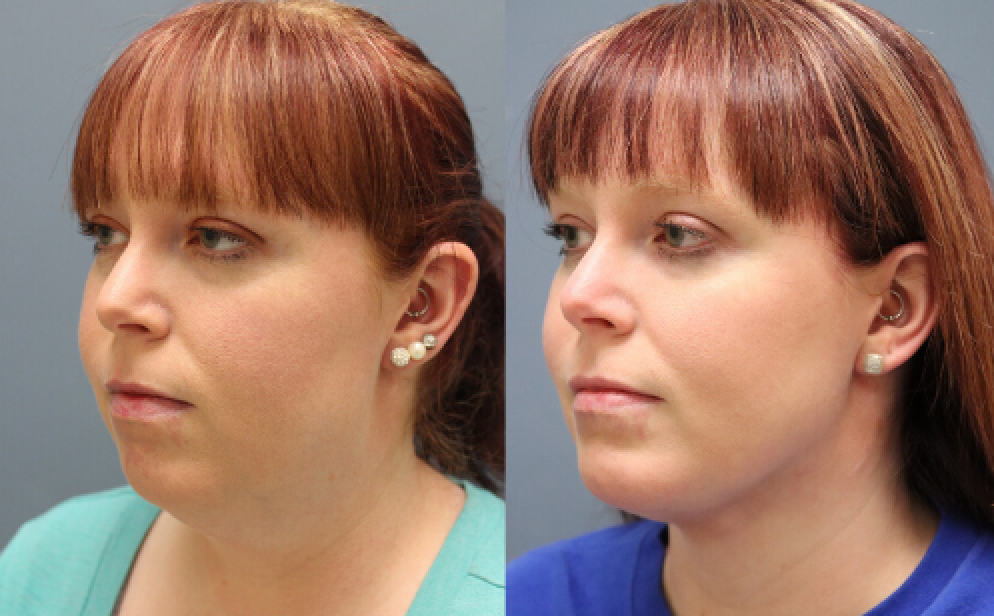  isolated submentoplasty before and after