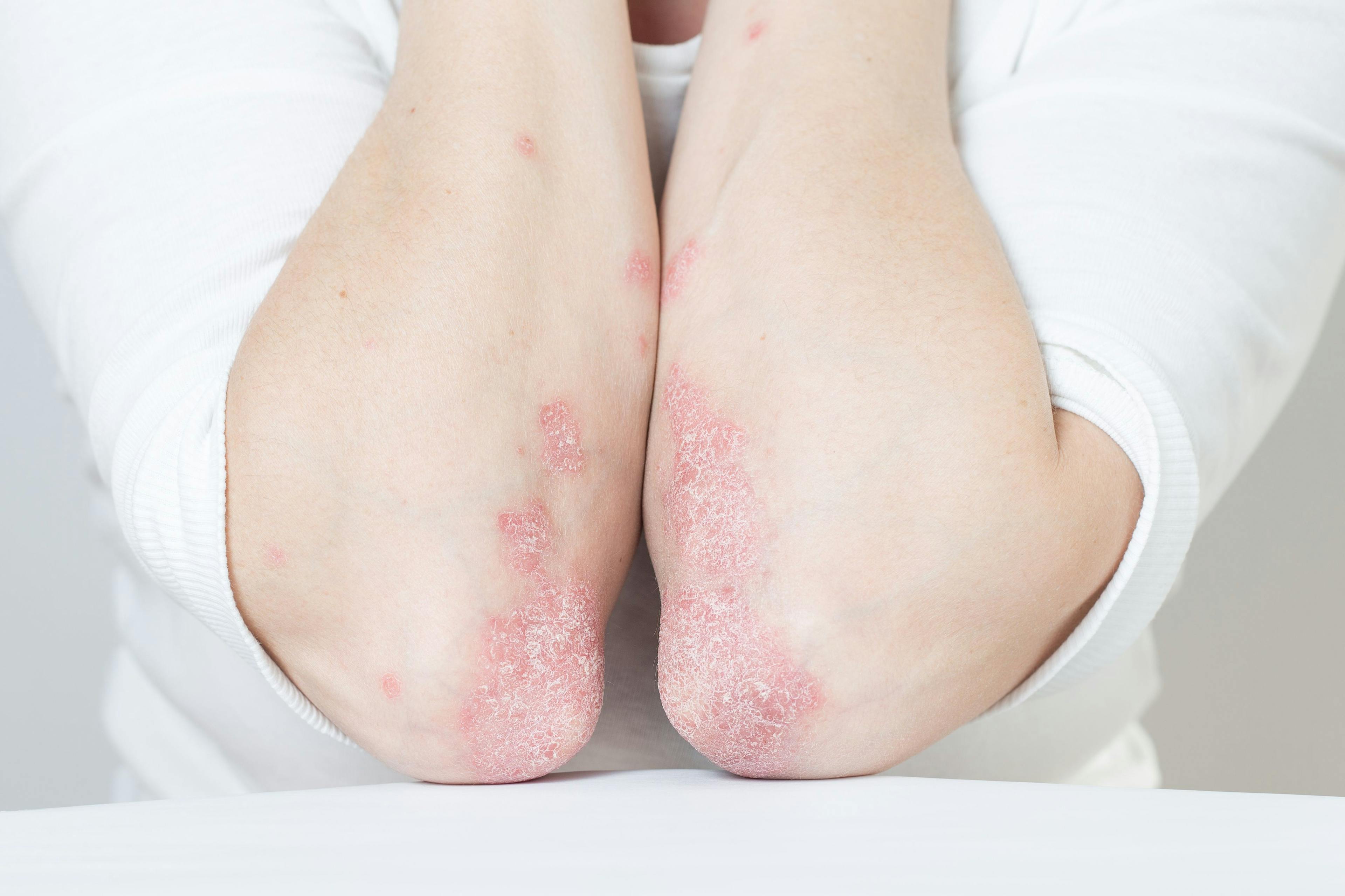 Risankizumab Met Co-Primary Endpoints in Patients With Moderate Plaque Psoriasis