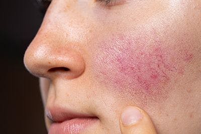 Specialized skincare regimen improves rosacea symptoms 