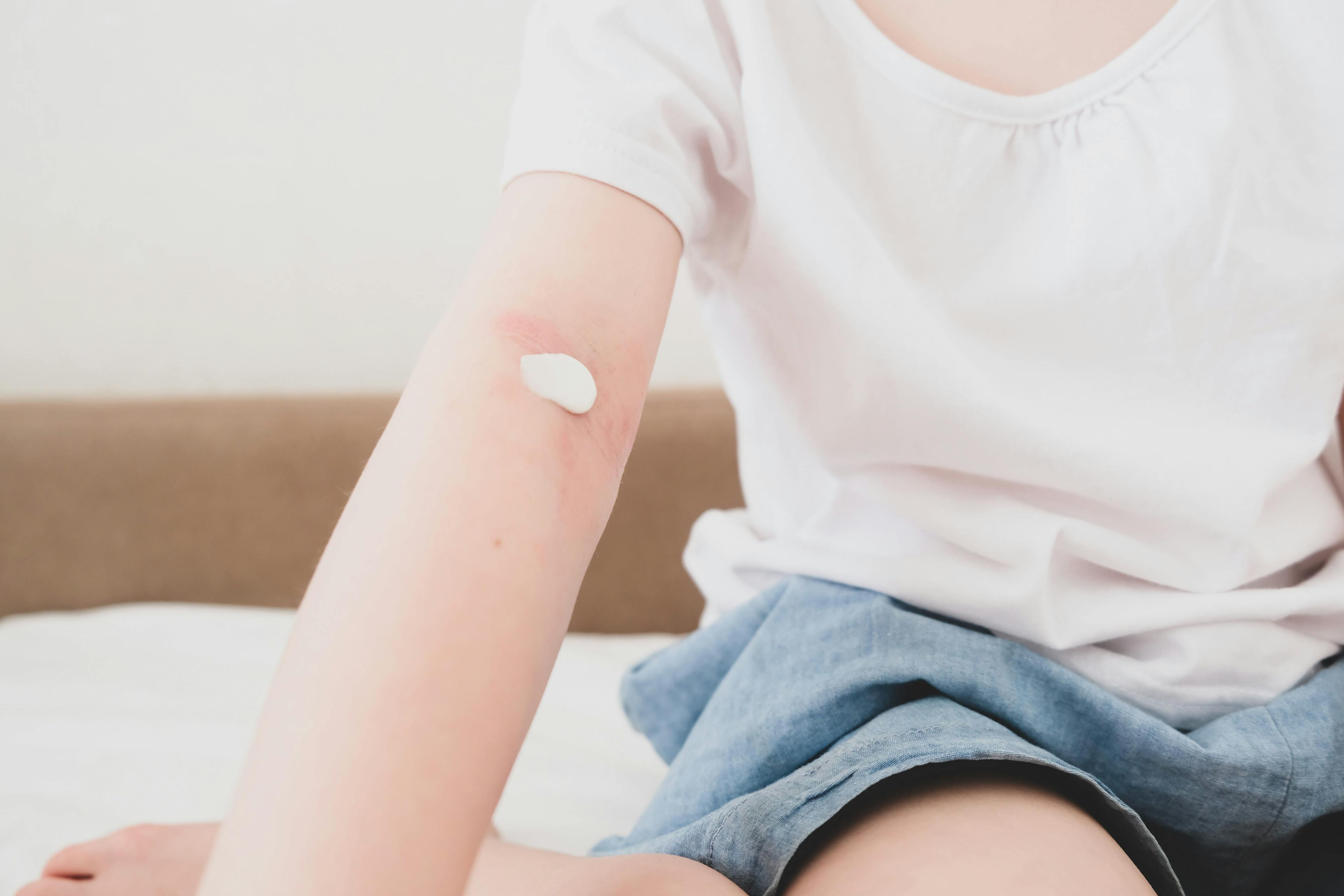 Available Atopic Dermatitis Therapies for Pediatric Patients