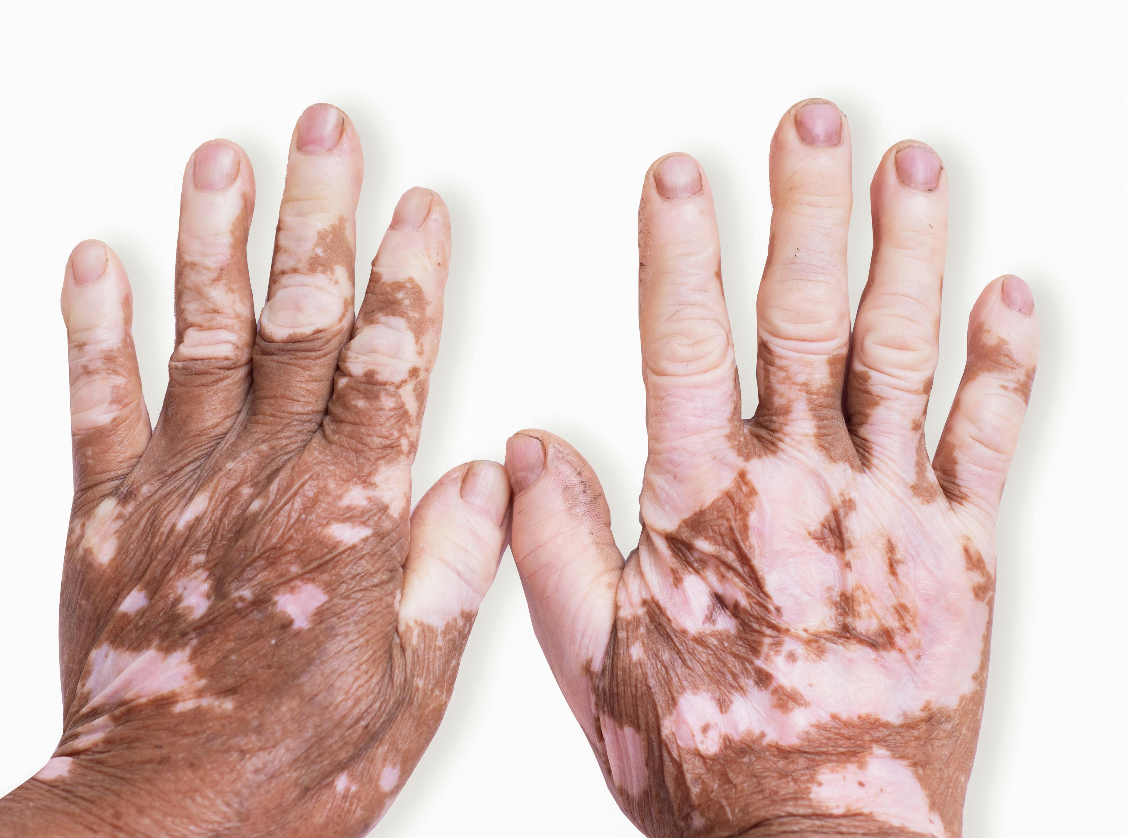 High Proportion of Patients With Vitiligo in the US Do Not Receive Treatment, Study Says
