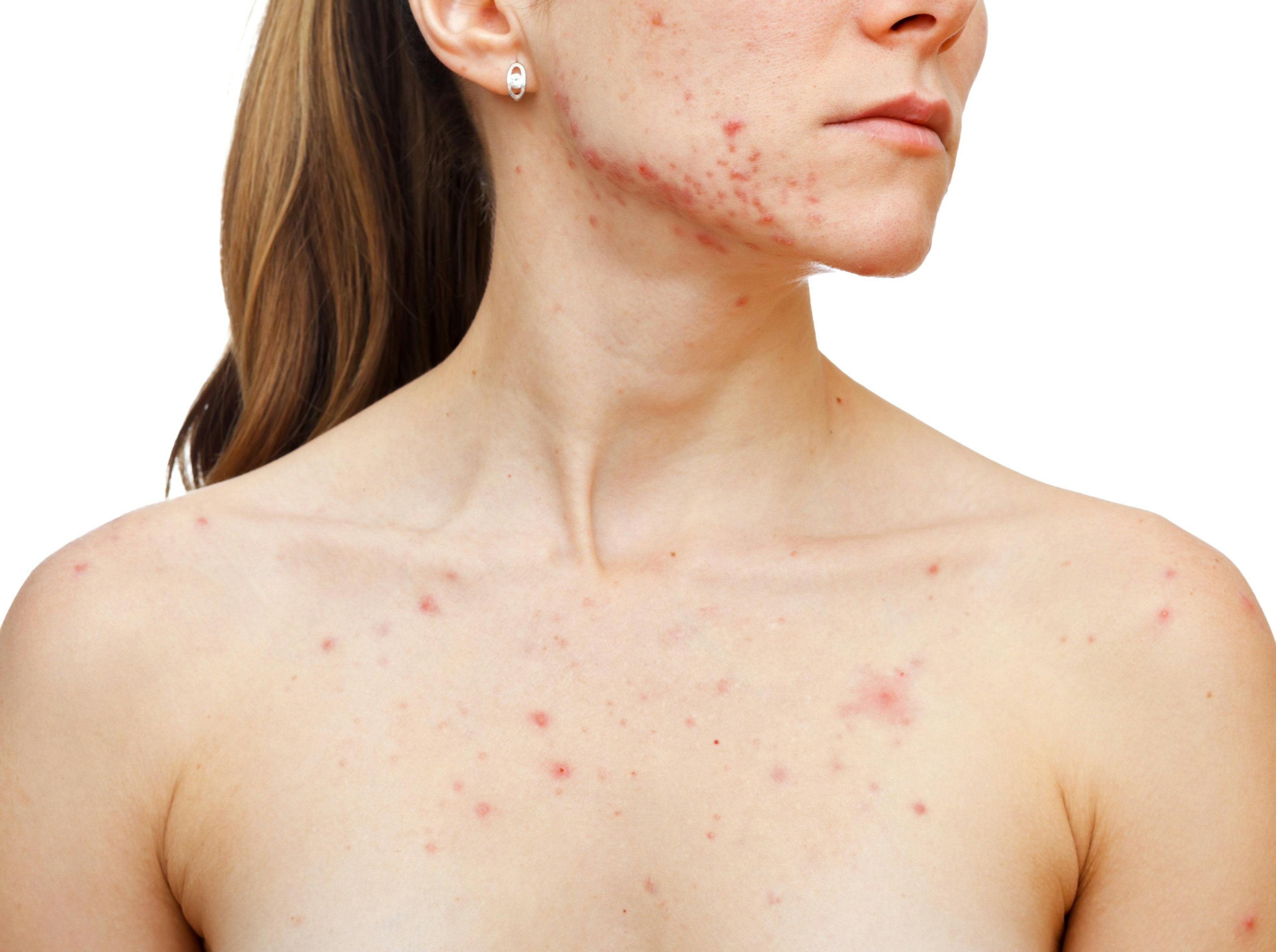 acne on face and chest