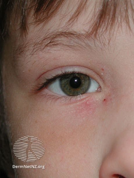 Atopic dermatitis on the eyelid (Image courtesy: DermNetNZ.org)