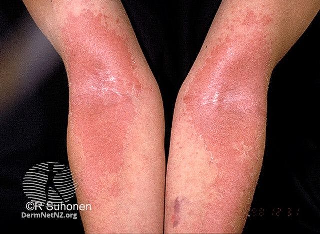 Long-Term Safety of Dupilumab in Adults with Moderate to Severe Atopic Dermatitis
