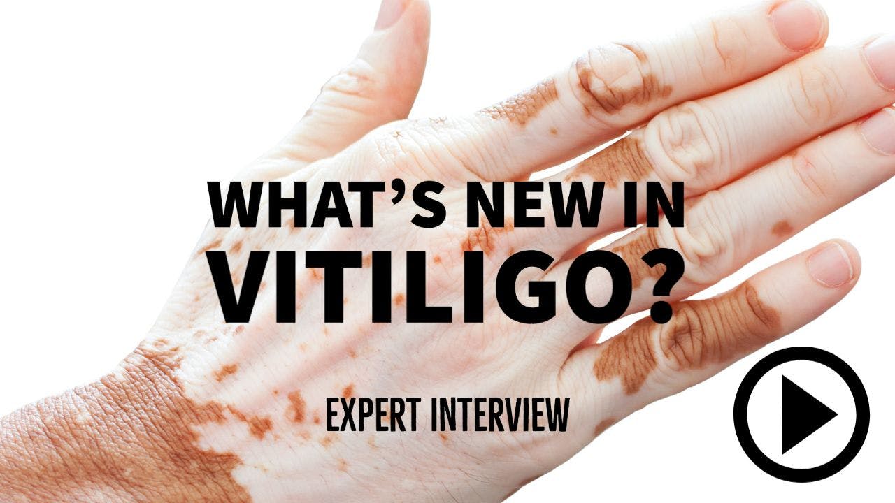 hand with vitiligo. Writing: "What's new in vitiligo - expert interview"