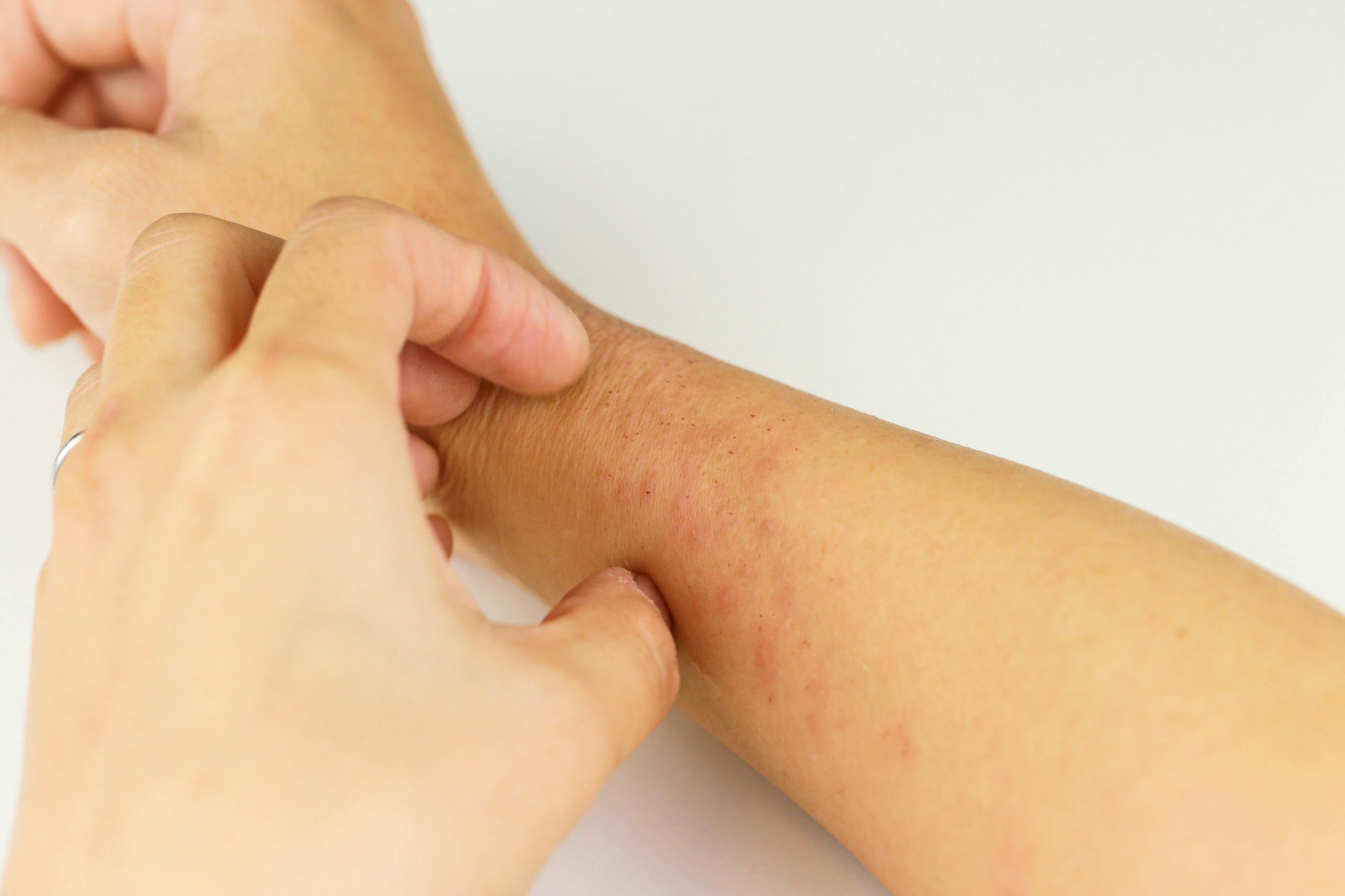 Inflammation-associated itching perceived as more intense