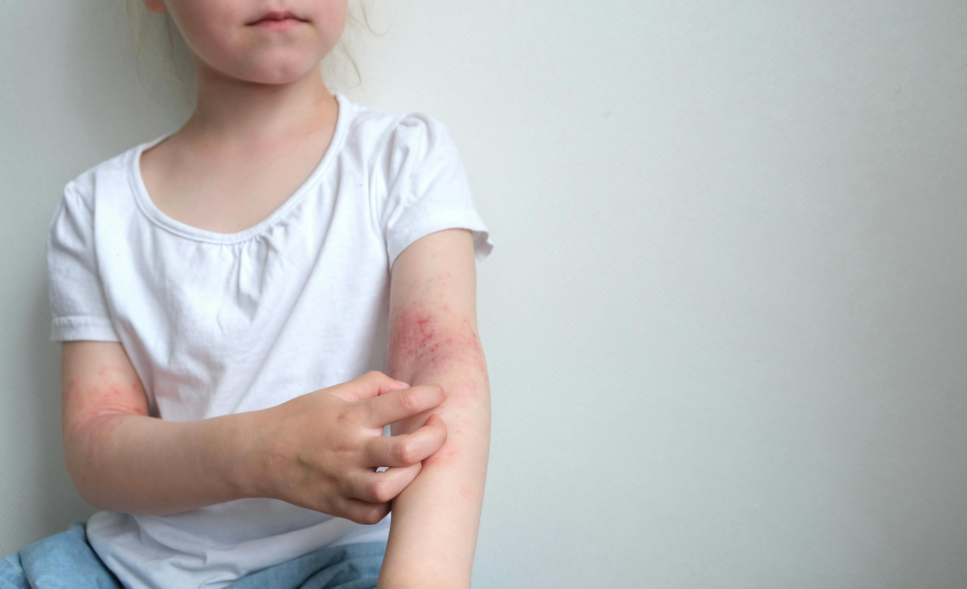 Baricitinib Offers Hope for Pediatric Atopic Dermatitis Patients