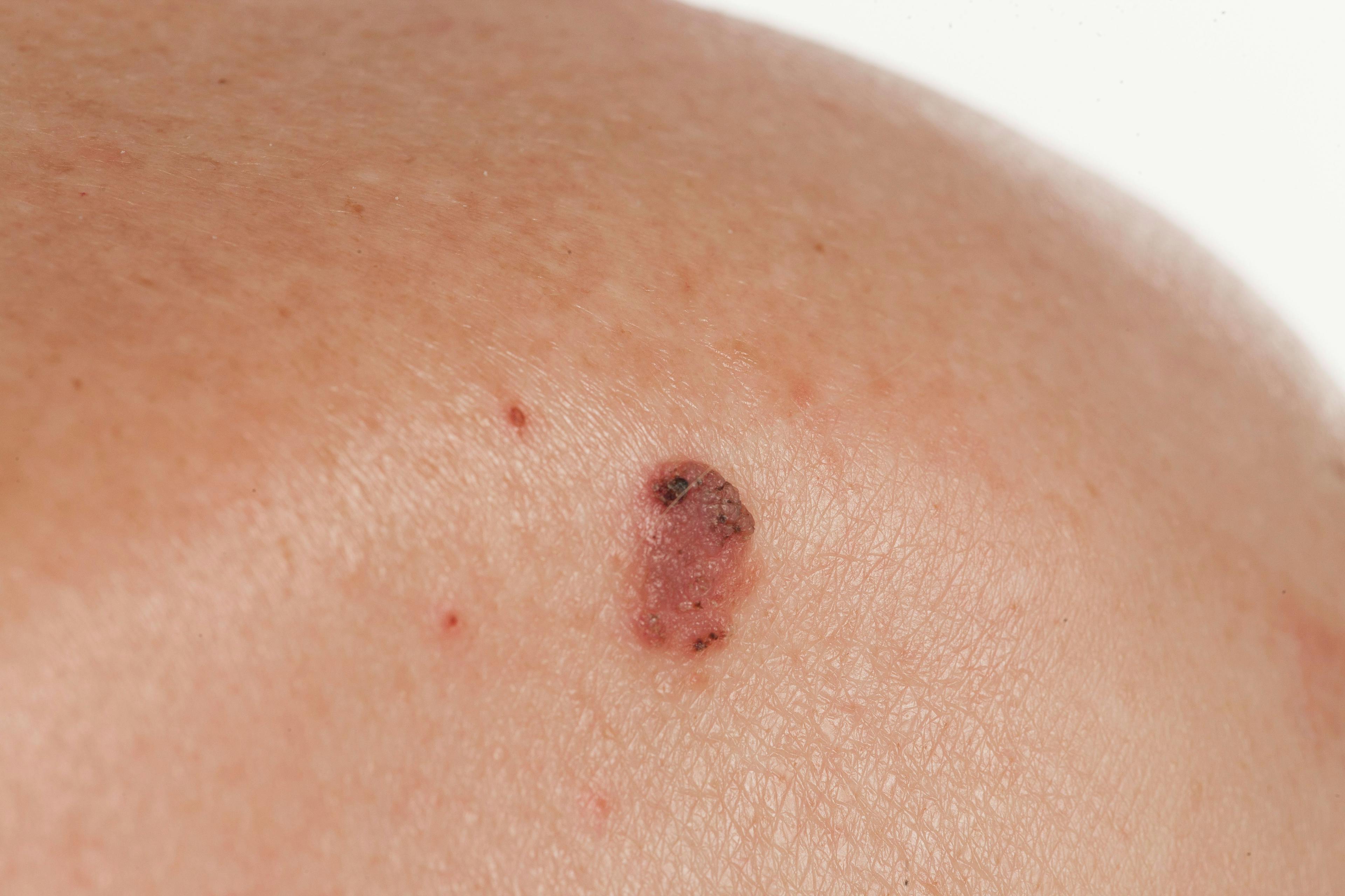 Phase I/II Study of Topical Biologic Shows Positive Results for the Treatment of Basal Cell Carcinoma