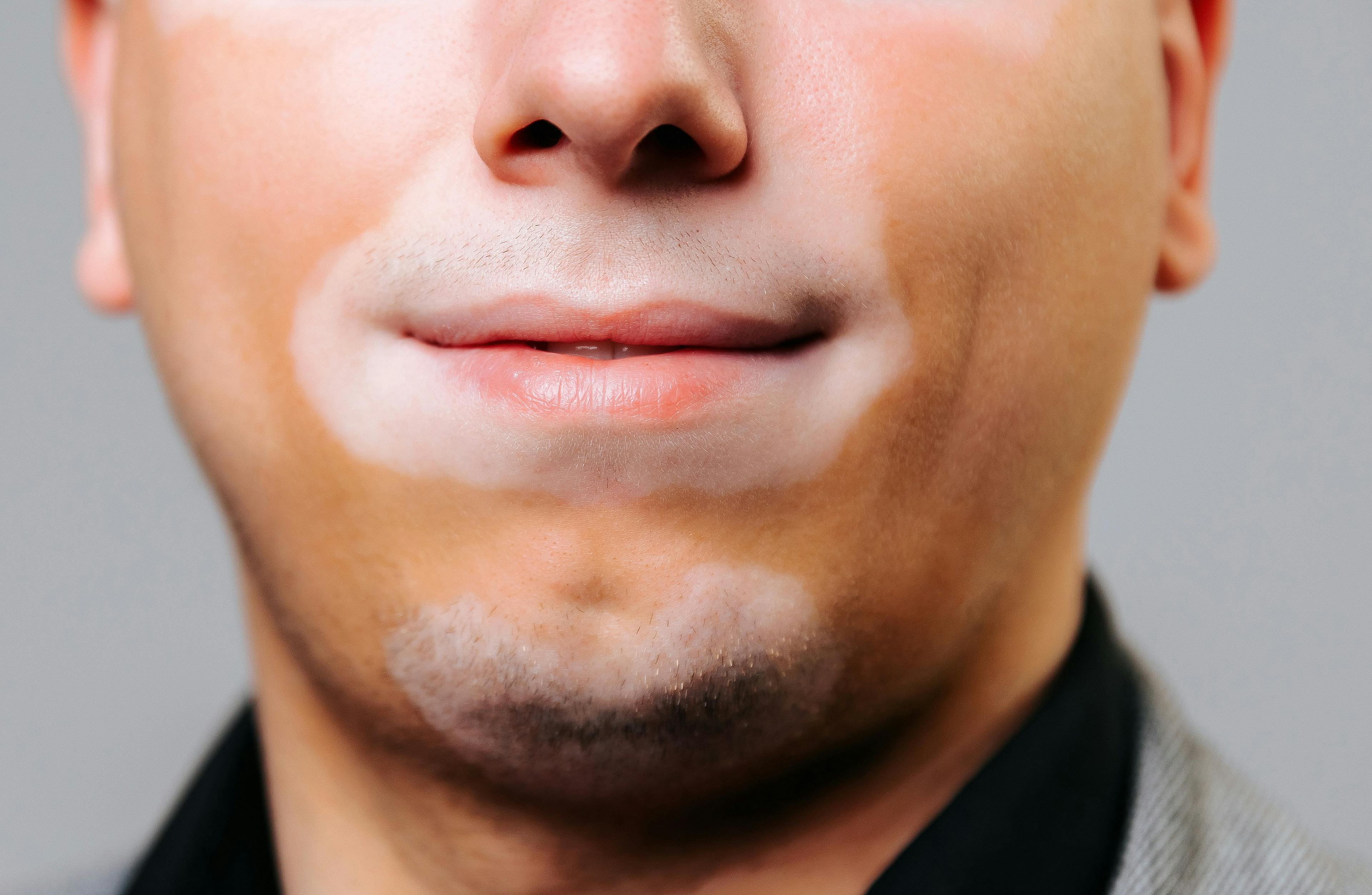 JAK Inhibitors Show Favorable Risk-Benefit Profile In Vitiligo, Especially for Facial Cases