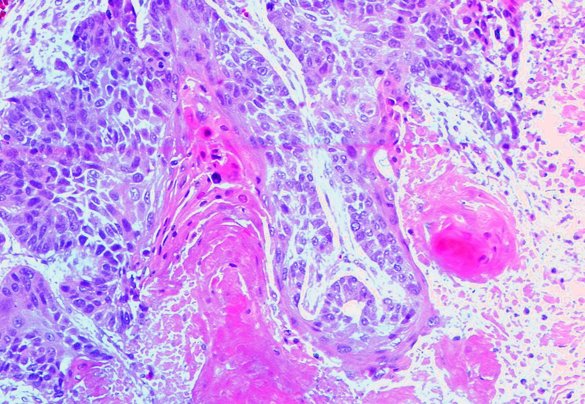 Squamous cell carcinoma

Image courtesy of Dr. Yale Rosen Atlas of Pulmonary Pathology