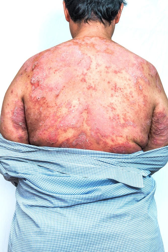 Psoriasis on back
