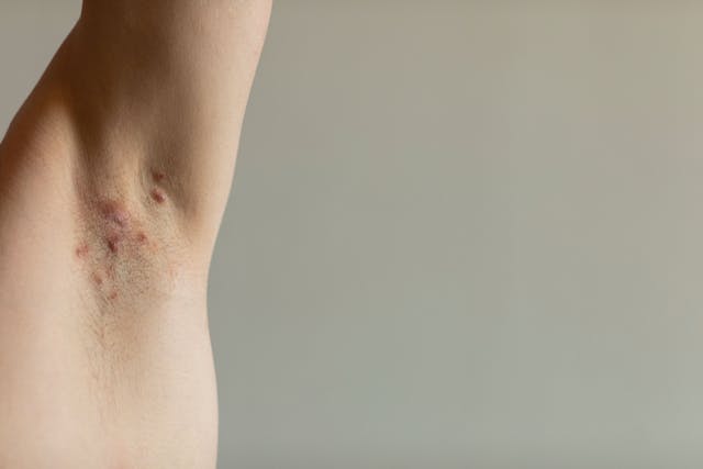 POLL: What is Your Recommended Treatment for Hidradenitis Suppurativa?