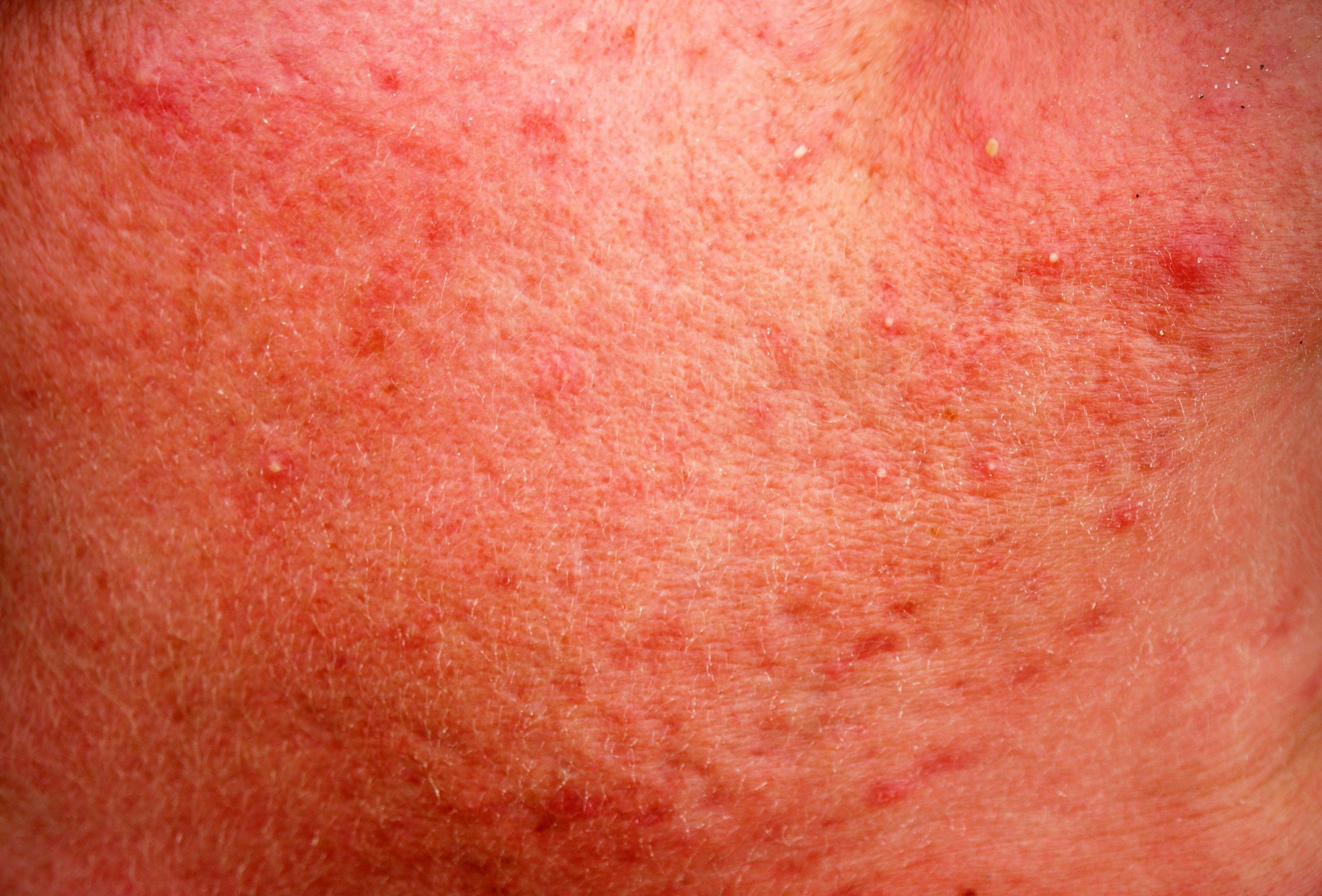 Age influences choice of rosacea therapies