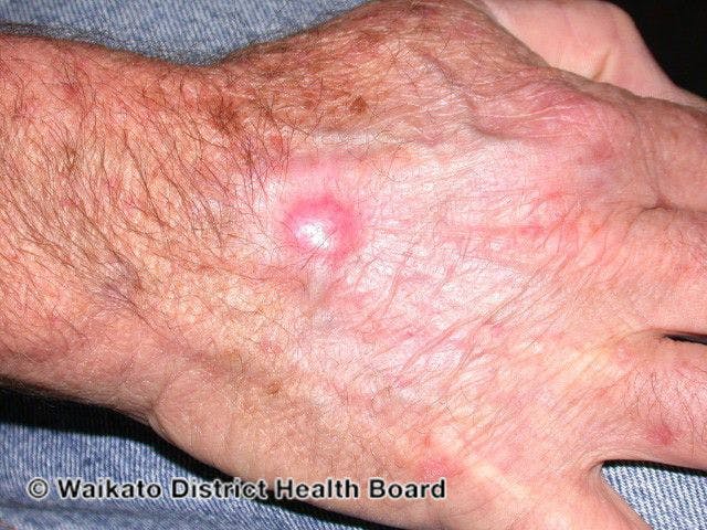 Recurrent basal cell carcinoma after imiquimod

Image courtesy of DermNet