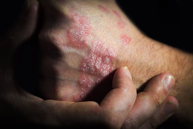IncRNA Combination Promotes Psoriasis Formation