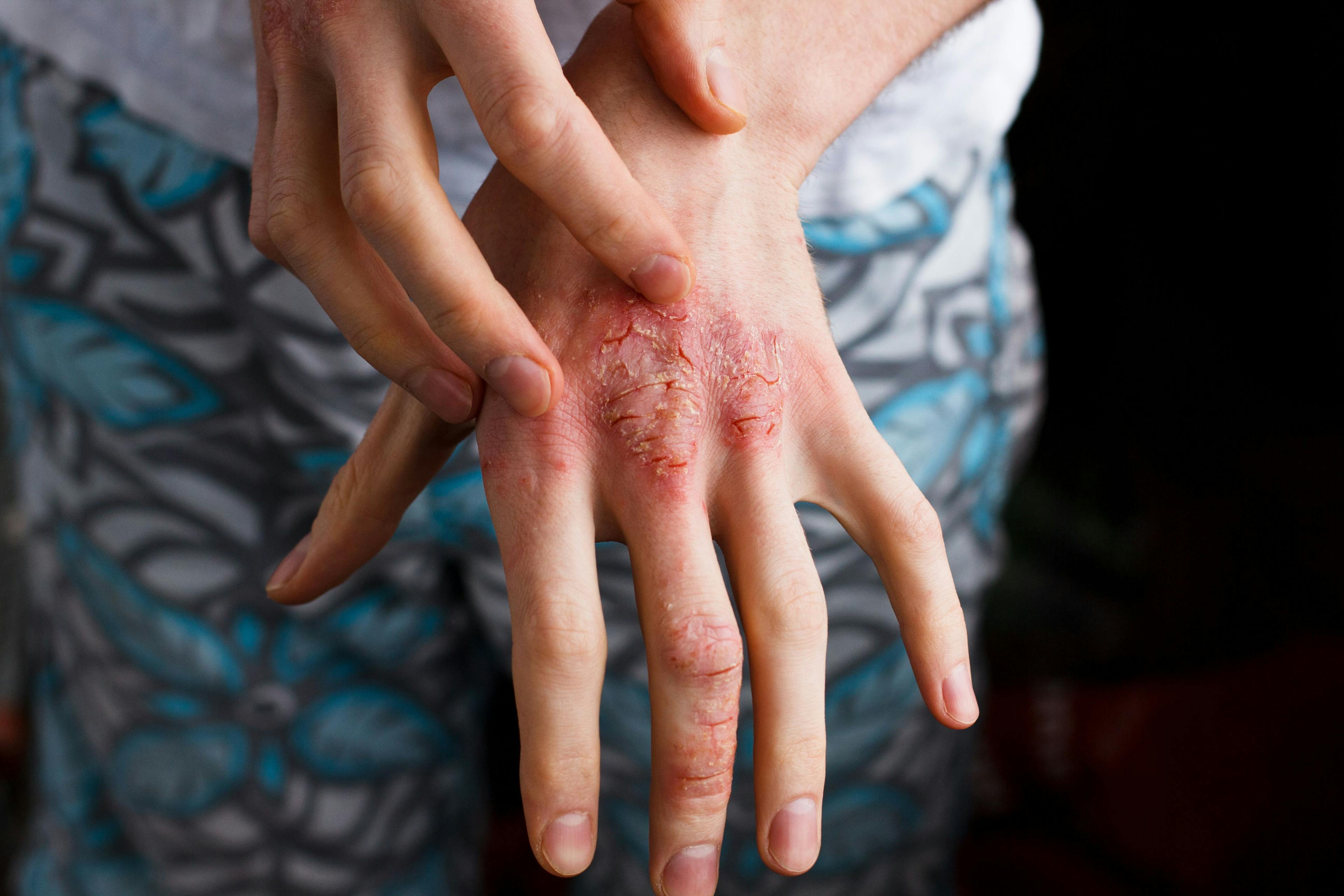 International Experts Reach Consensus on Uniform Dosing of Methotrexate for Psoriasis