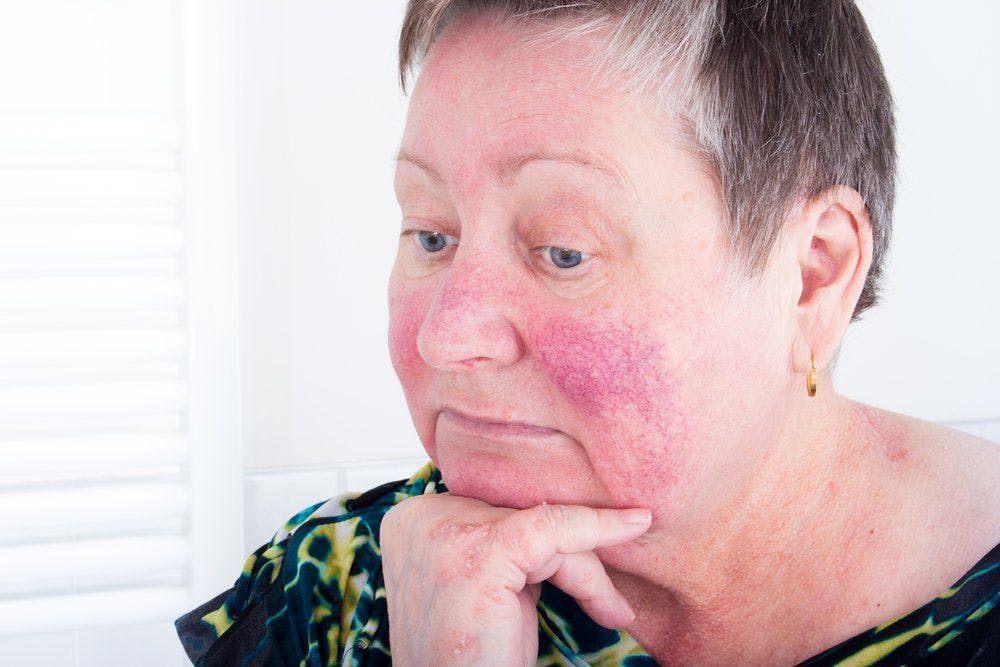 Quality of life, mental health issues common in rosacea, PsO patients 