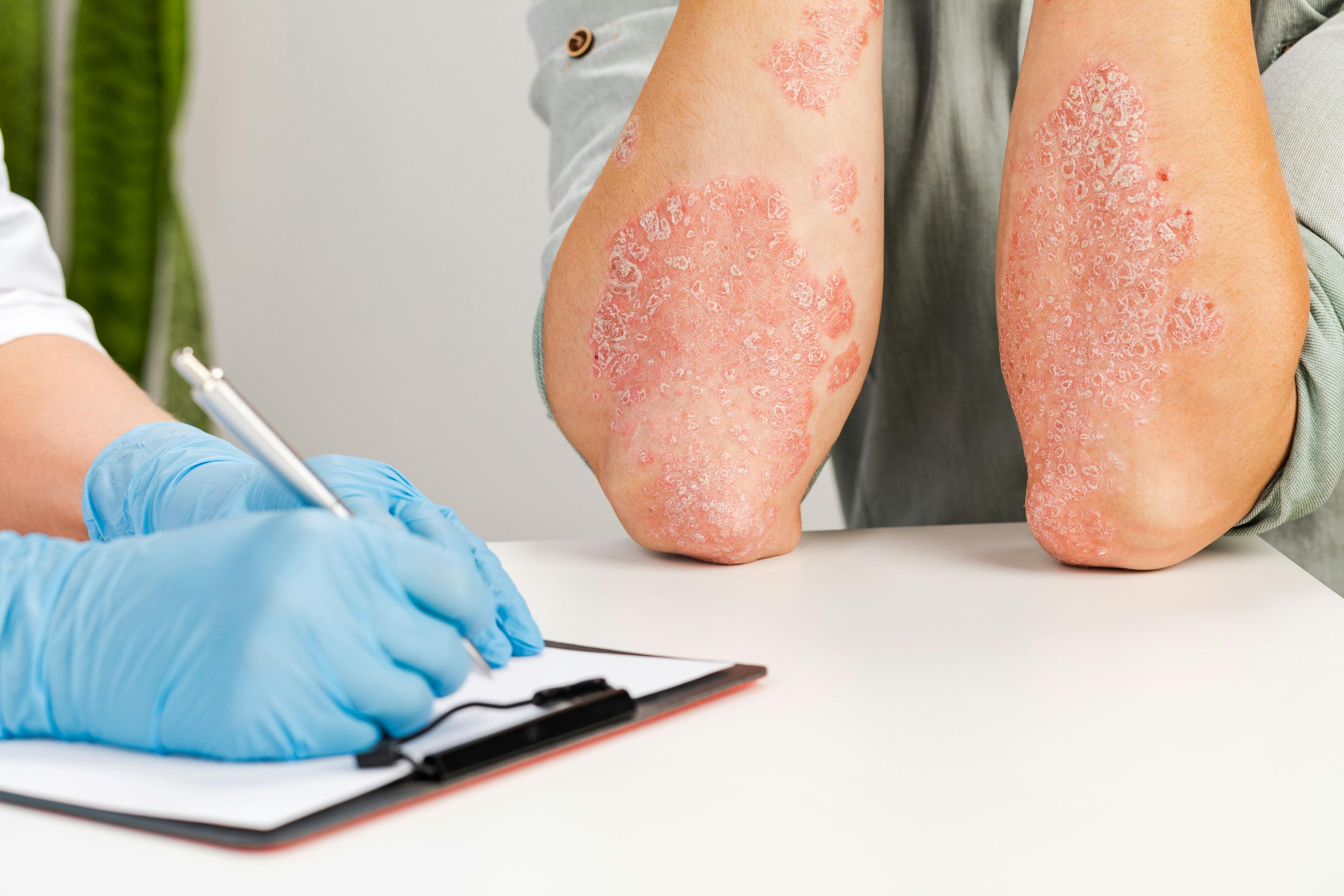Half of Patients With Psoriasis Receiving Placebo In Clinical Trials Report Adverse Events