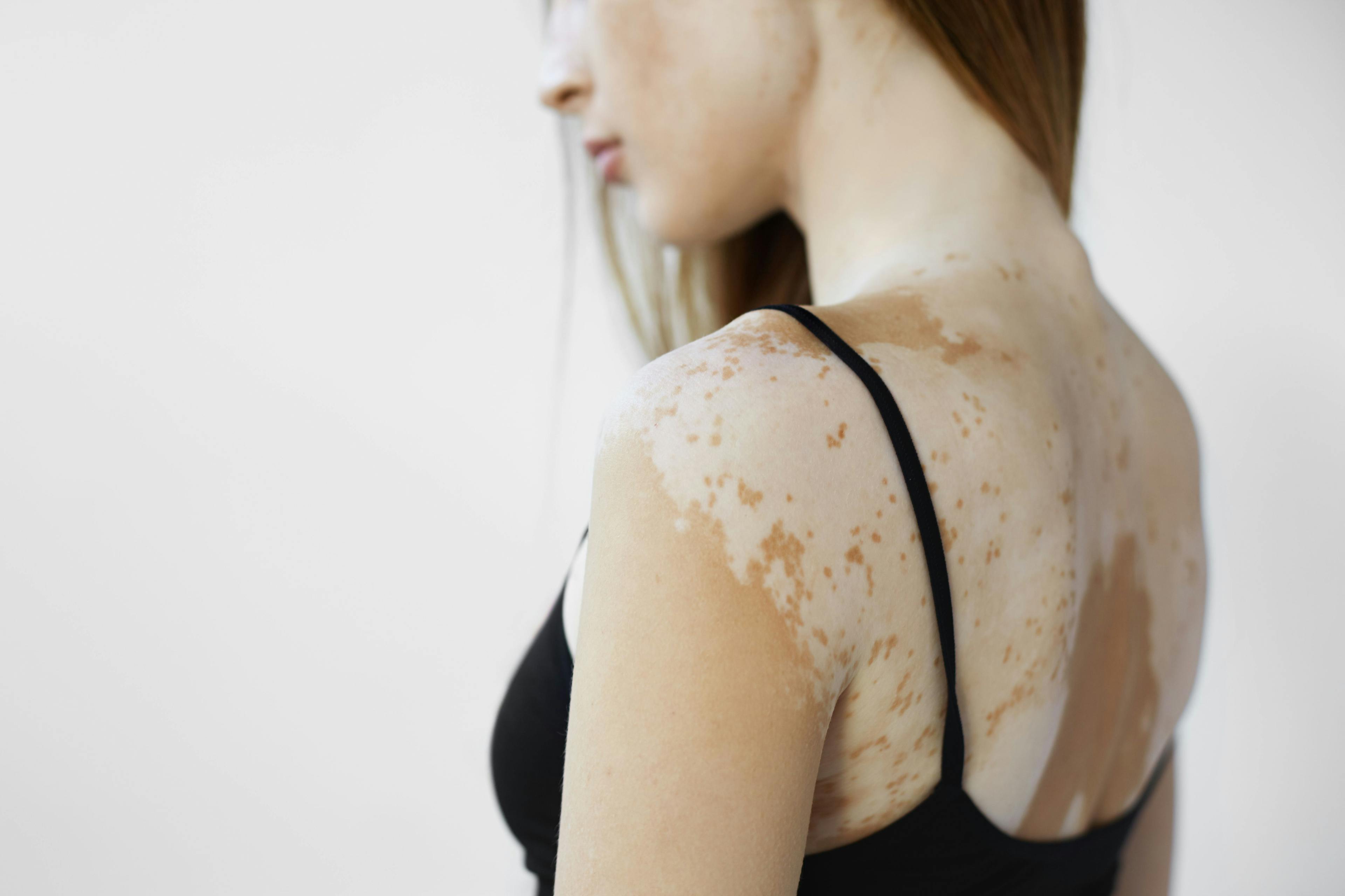 How Ruxolitinib Will Change the Future of Vitiligo Treatment 
