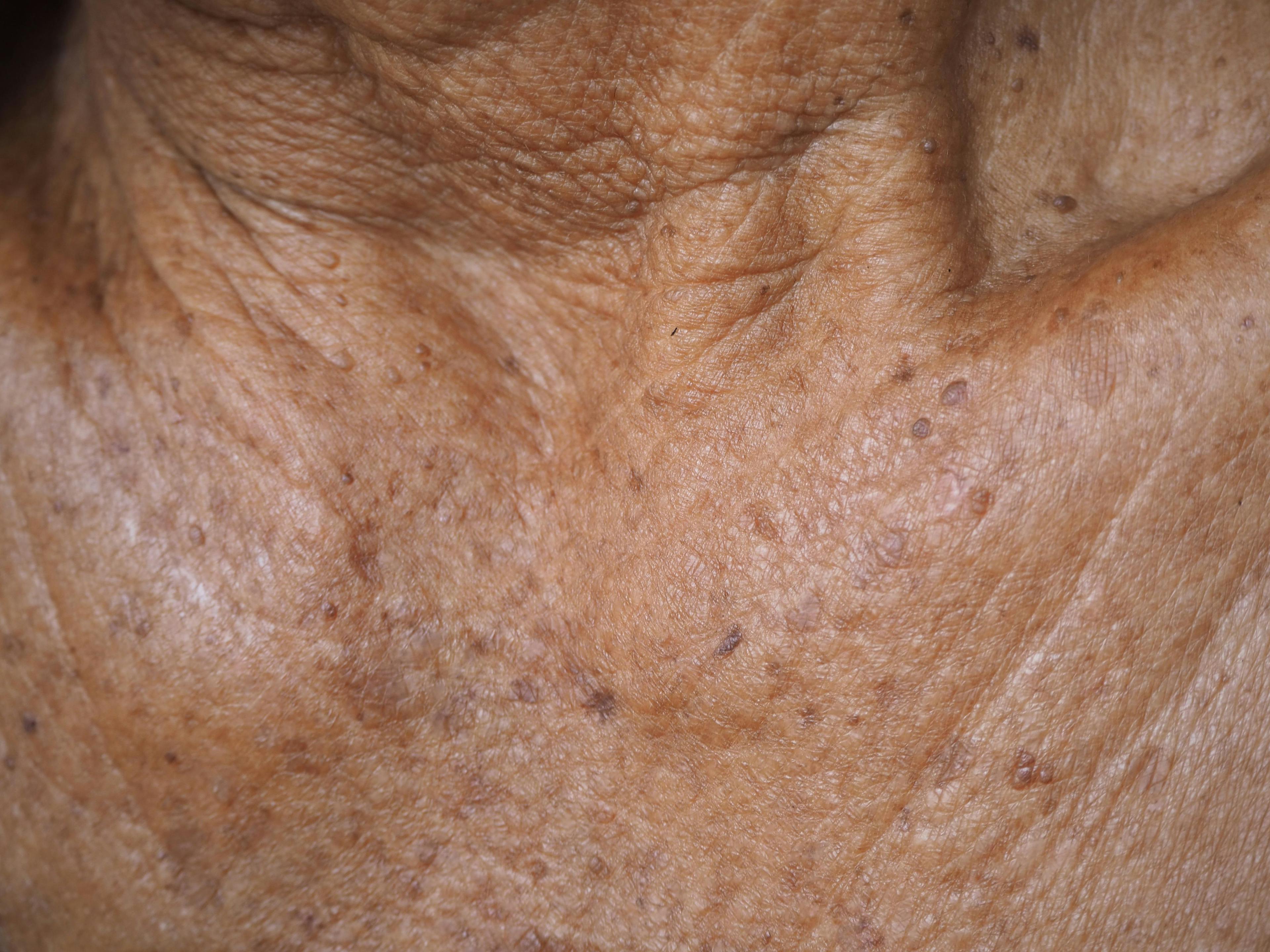 FDA approves topical for actinic keratosis 