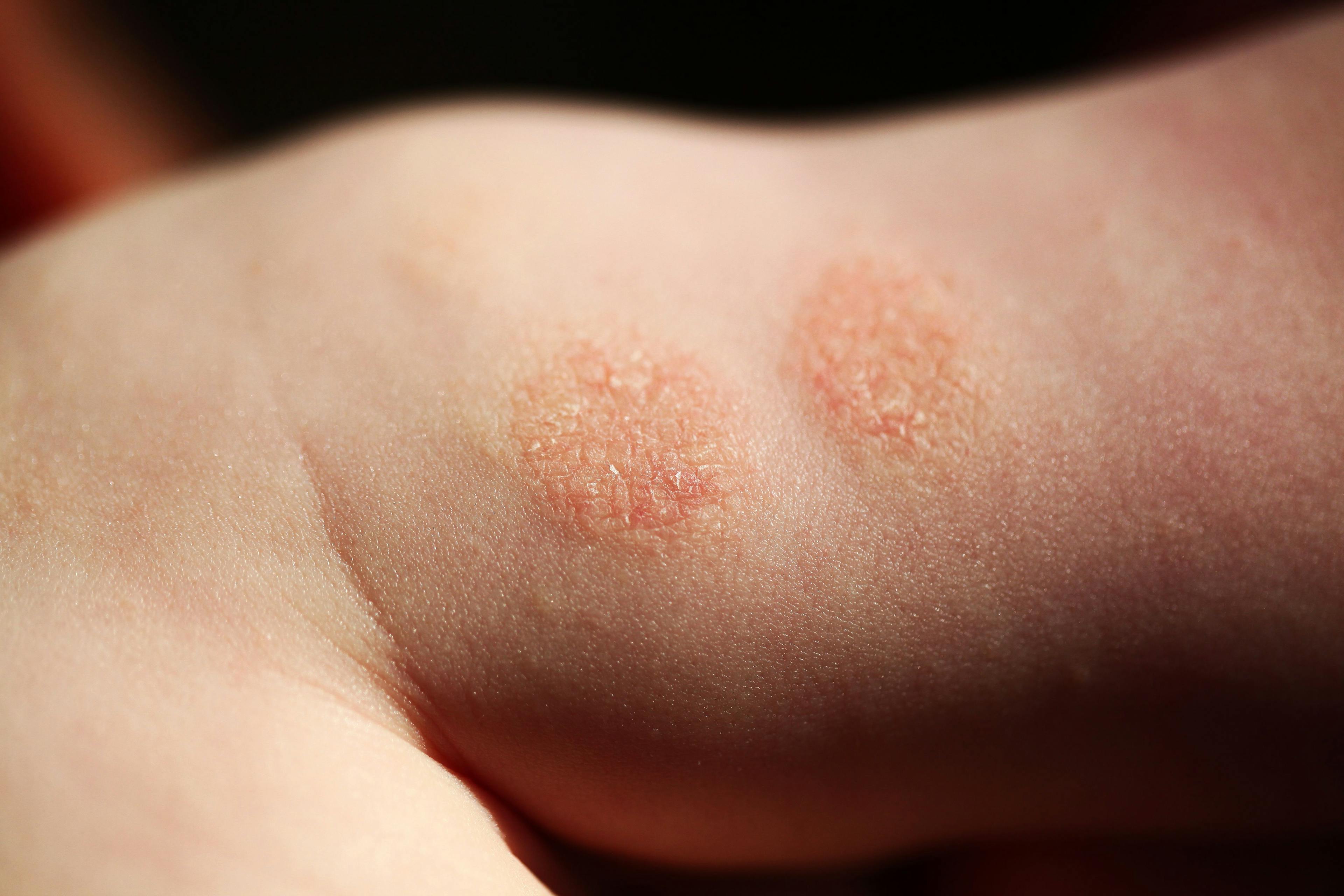 Eczema Global Scorecard: Patients Struggling to Control Symptoms