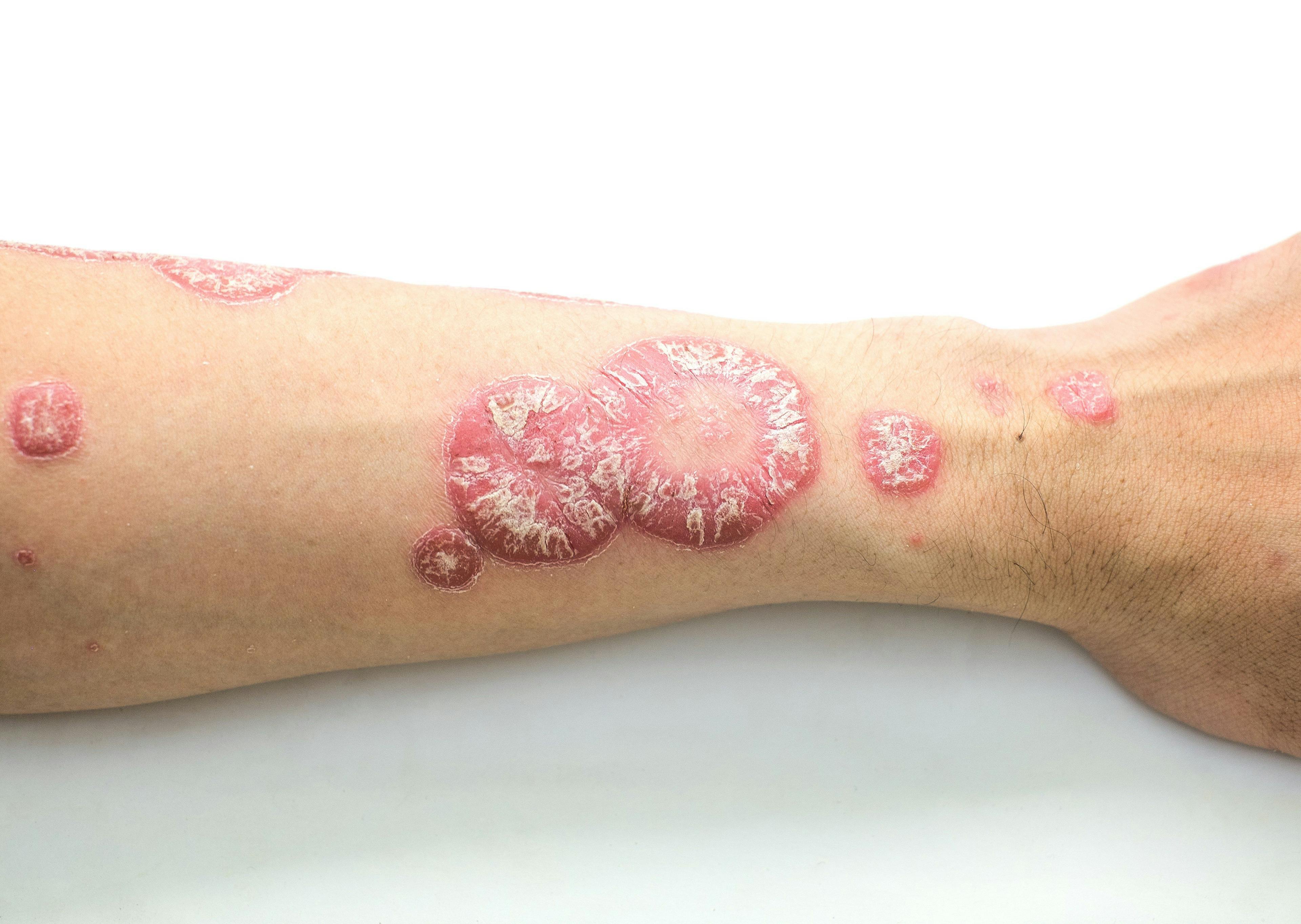 Patches of red, flaky skin on arm