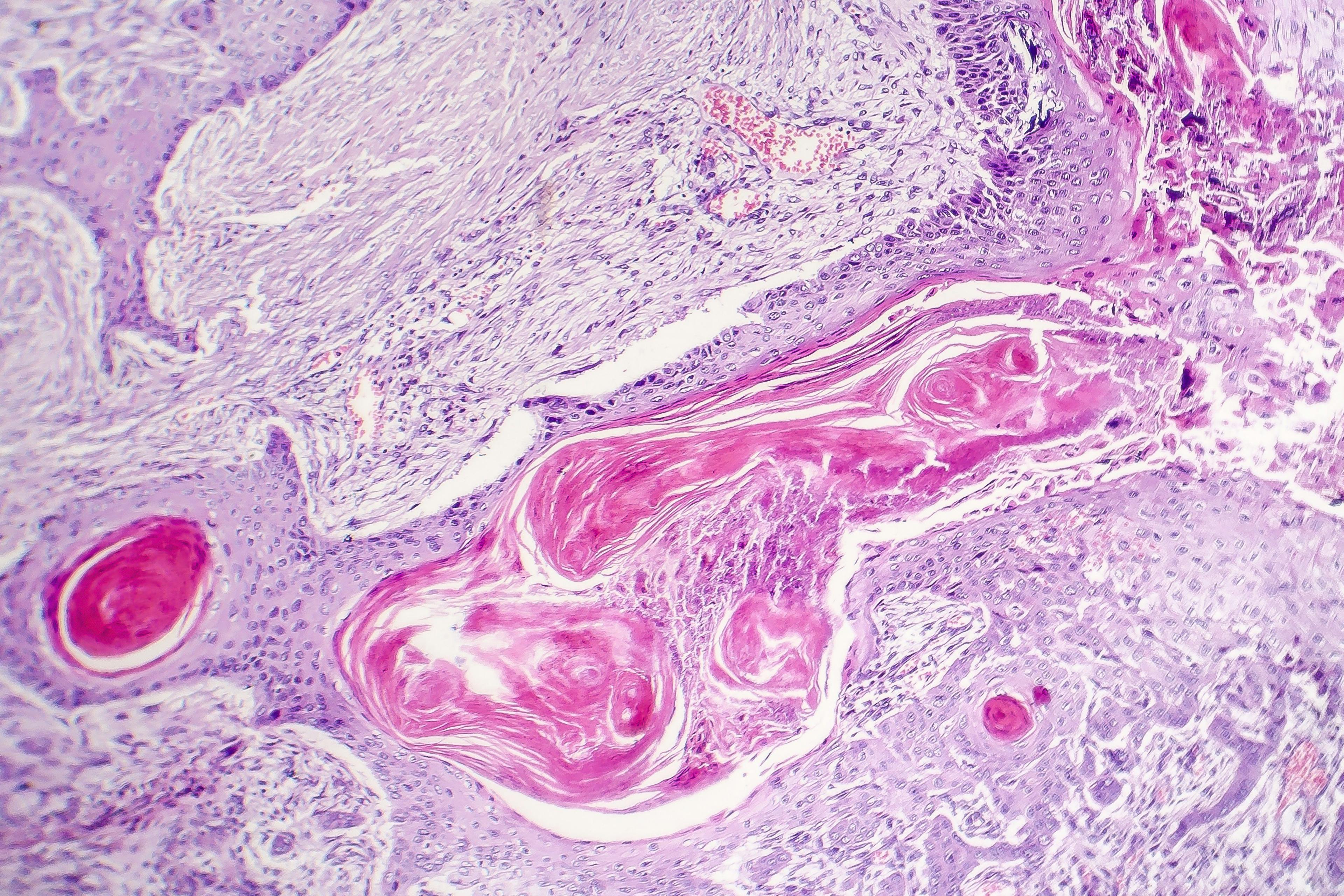 Cutaneous squamous cell carcinoma