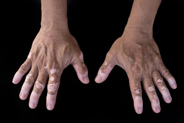 First Case Report of Vitiligo Triggered by Dupilumab Treatment