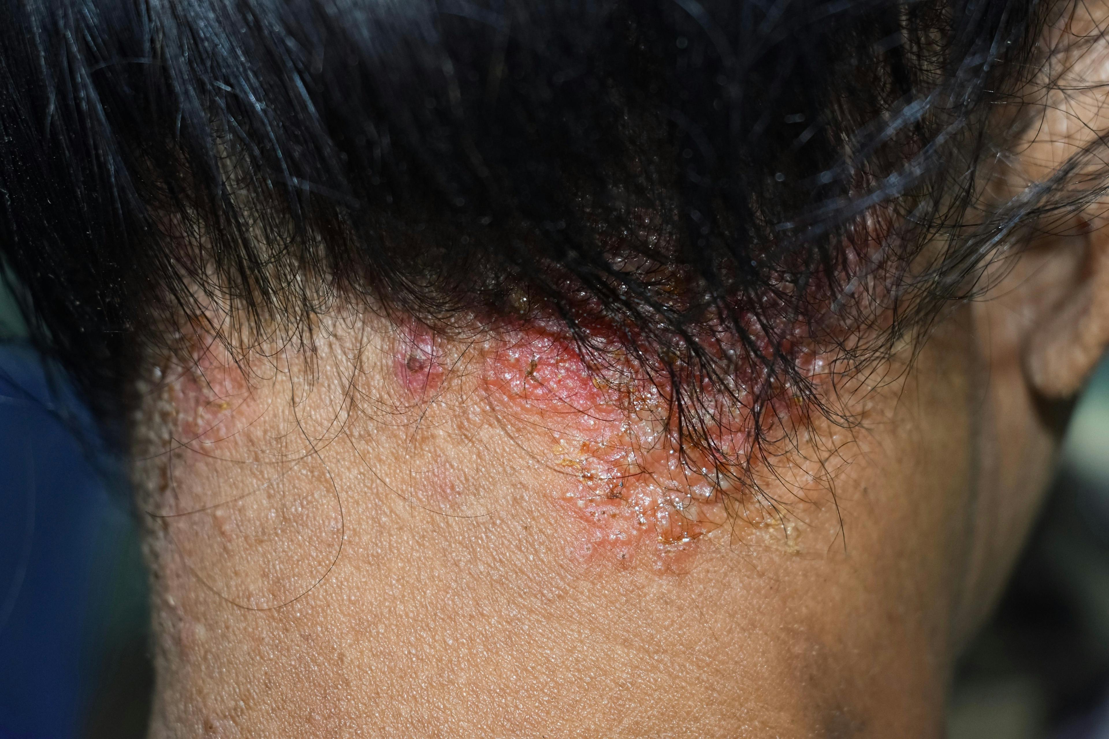 Study Reveals HCPs Underestimate Burden of Disease Associated With Seborrheic Dermatitis