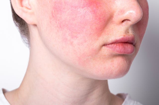 Variable-Sequenced Large-Spot KTP and PDL Demonstrate Comparable Efficacy in Rosacea