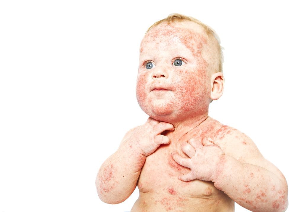 pediatric atopic dermatitis 