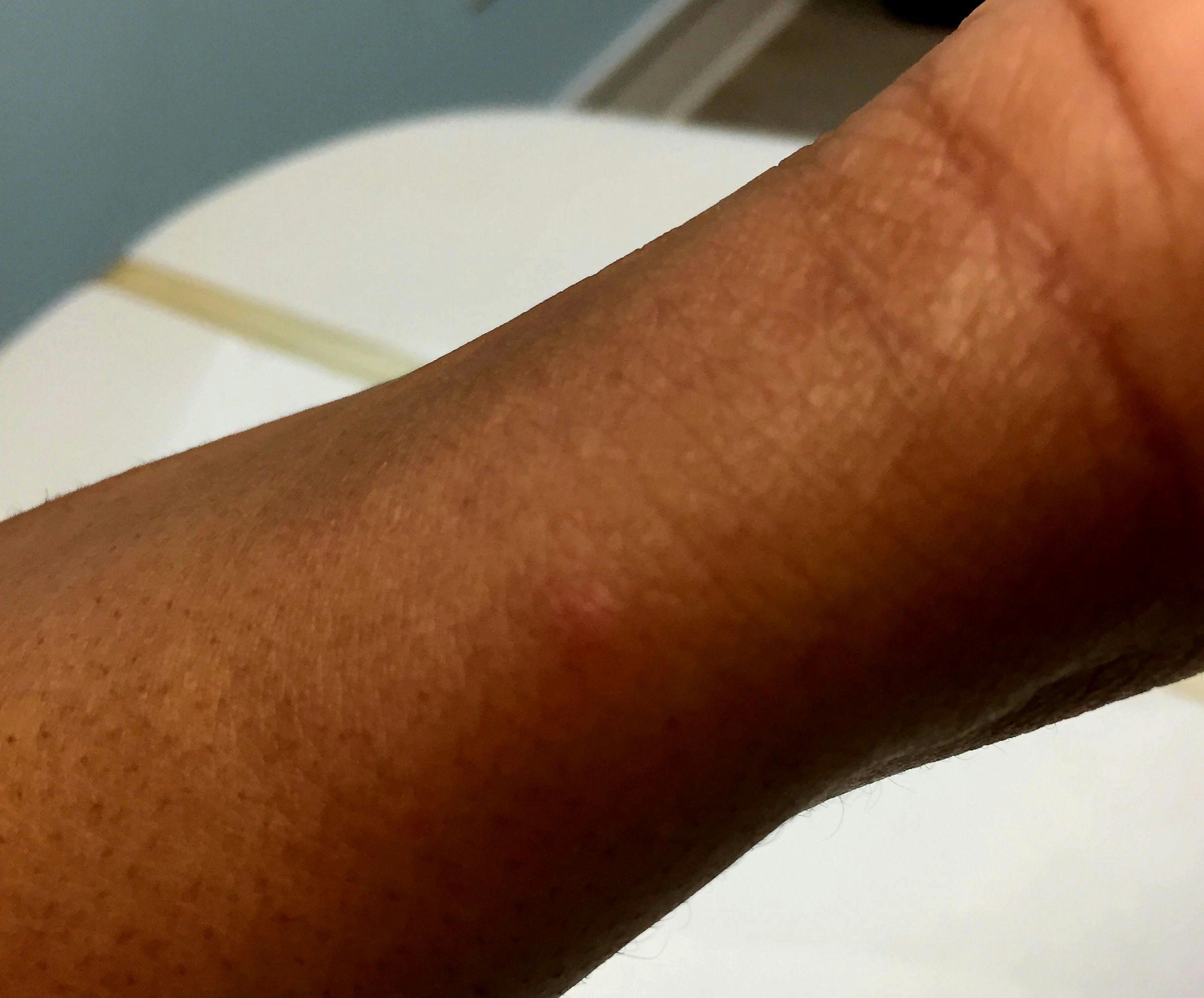 Mosquito bite on a patient with skin of color

Image courtesy of Block