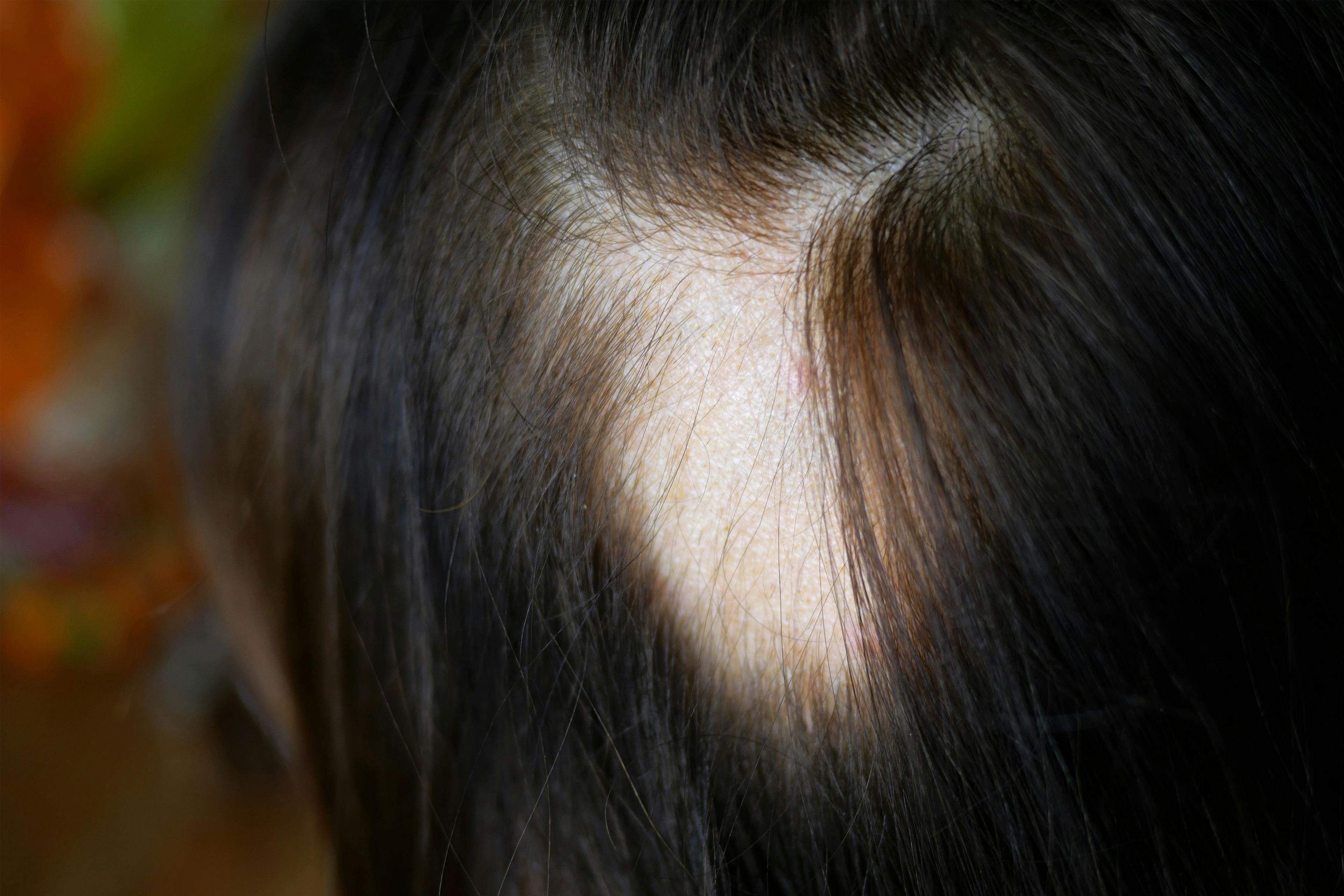Methotrexate, Low-Dose Prednisone Efficacious in Alopecia Treatment